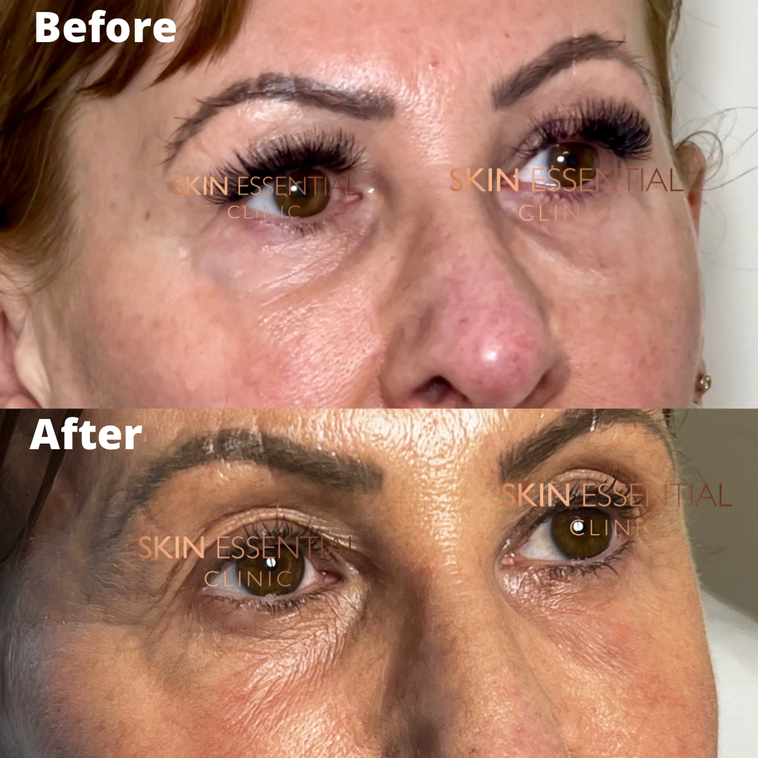 Close-up of a woman's face showing before and after cosmetic treatment, highlighting improvements around her eyes and skin texture.