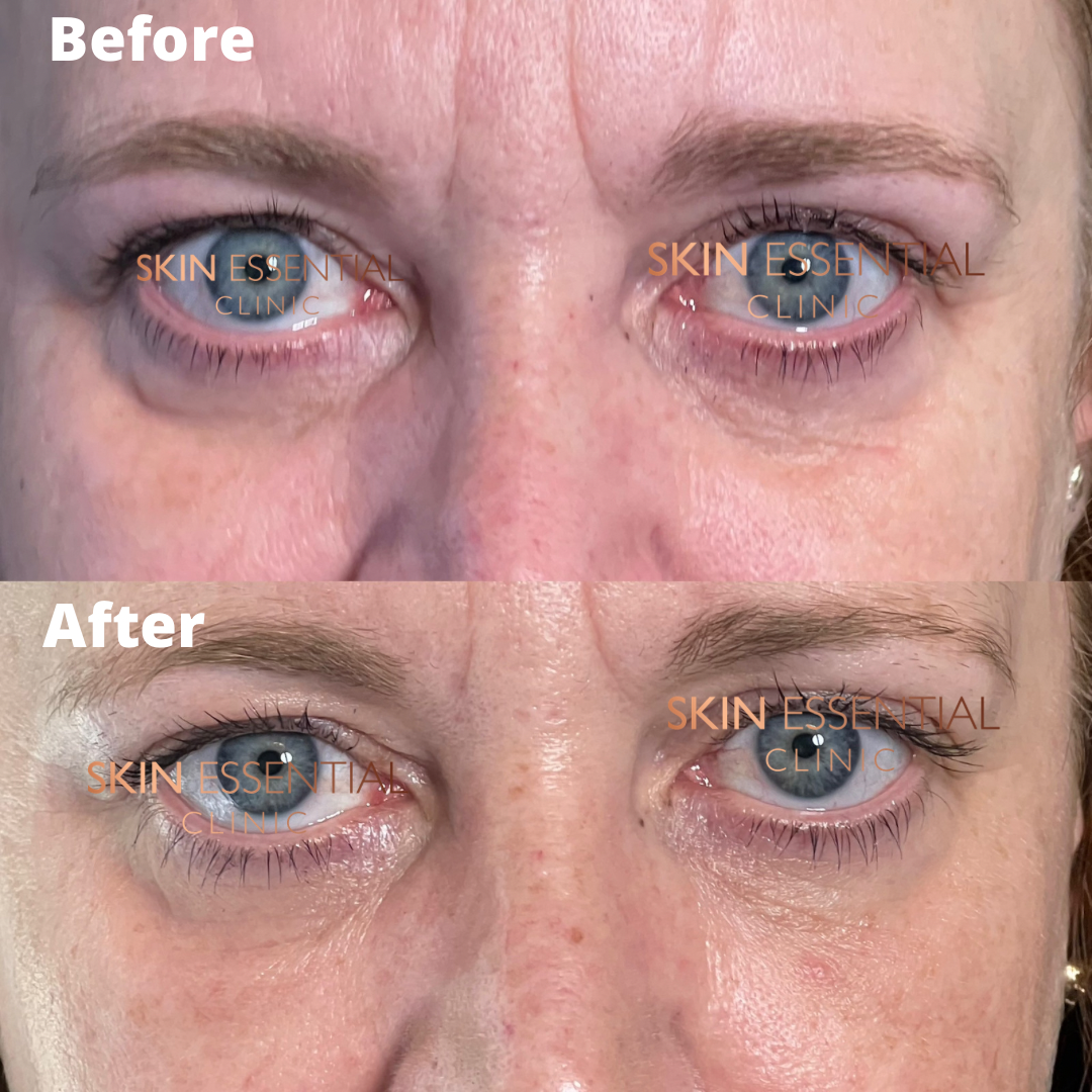 Comparison photo showing a person's face before and after a skincare treatment, focusing on the eye area, with improved skin texture and reduced puffiness in the after image.
