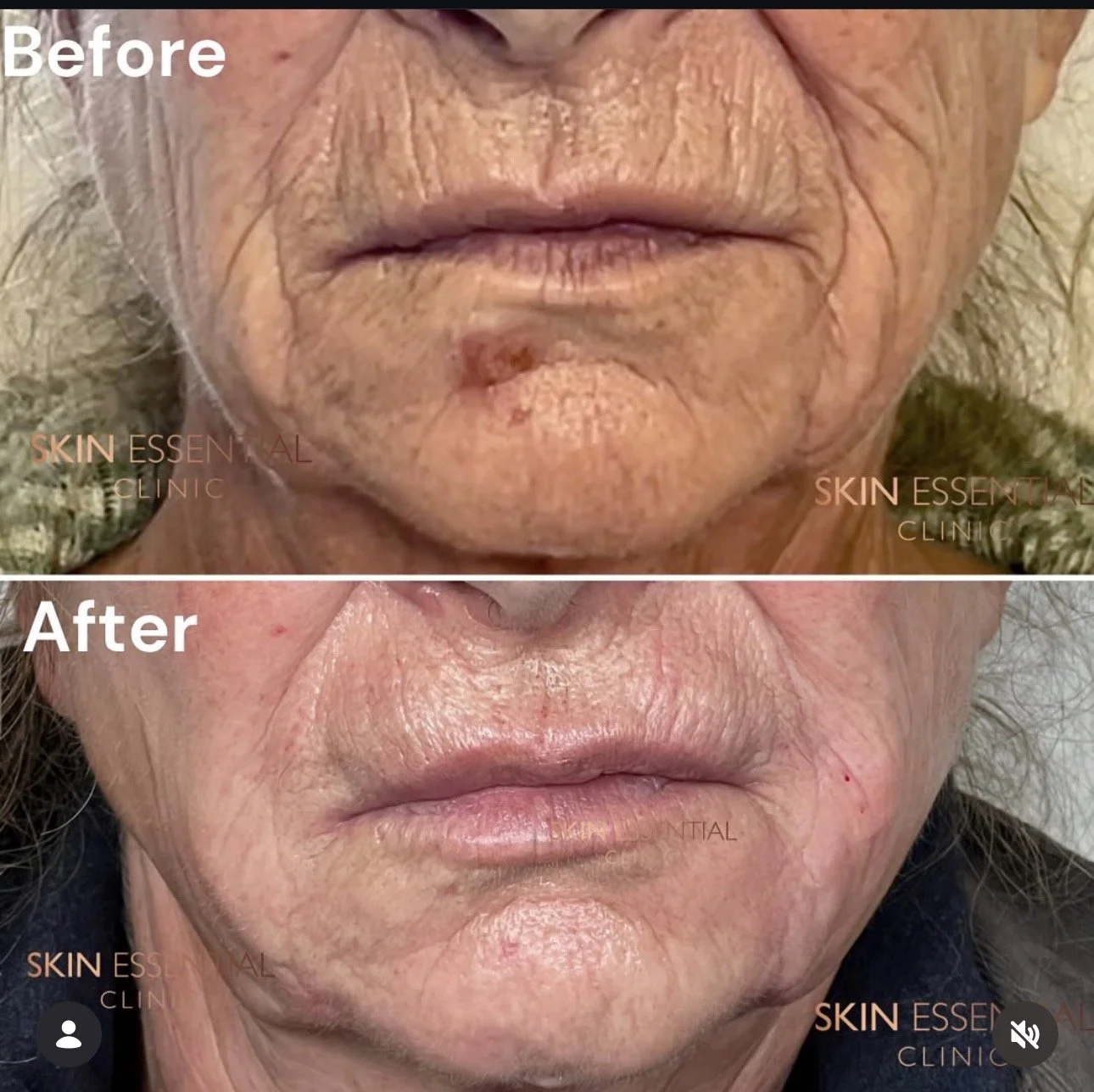 A side-by-side comparison of a person's lower face showing before and after skin treatment. The 'Before' image displays wrinkled, sagging skin with age spots, while the 'After' image shows smoother, tighter skin with fewer lines and spots.