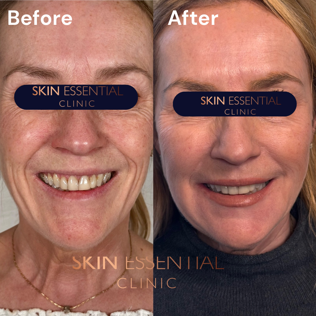 Comparison image showing a woman before and after skin treatment, smiling in both photos, with visible improvements in skin texture and tone.