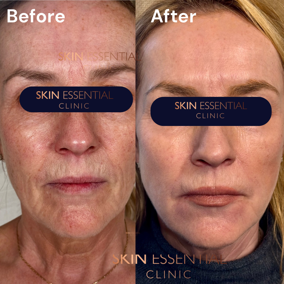 Before and after images showing skin improvement, with the left side labeled 'Before' and the right side labeled 'After.'