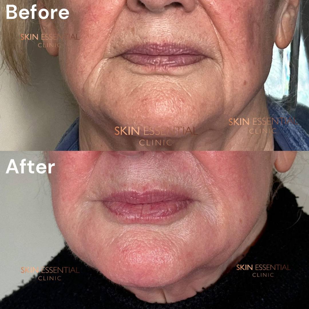 Comparison of a person's lips and lower face before and after a cosmetic treatment, showing improvements in skin texture and lip fullness.