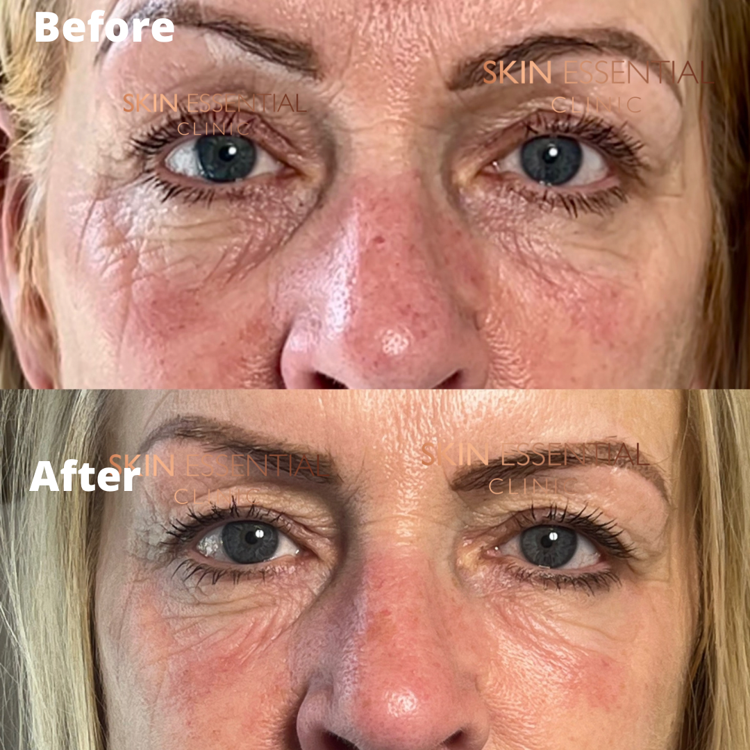 Comparison of a woman's eye area before and after skincare treatment showing reduced wrinkles and improved skin texture.