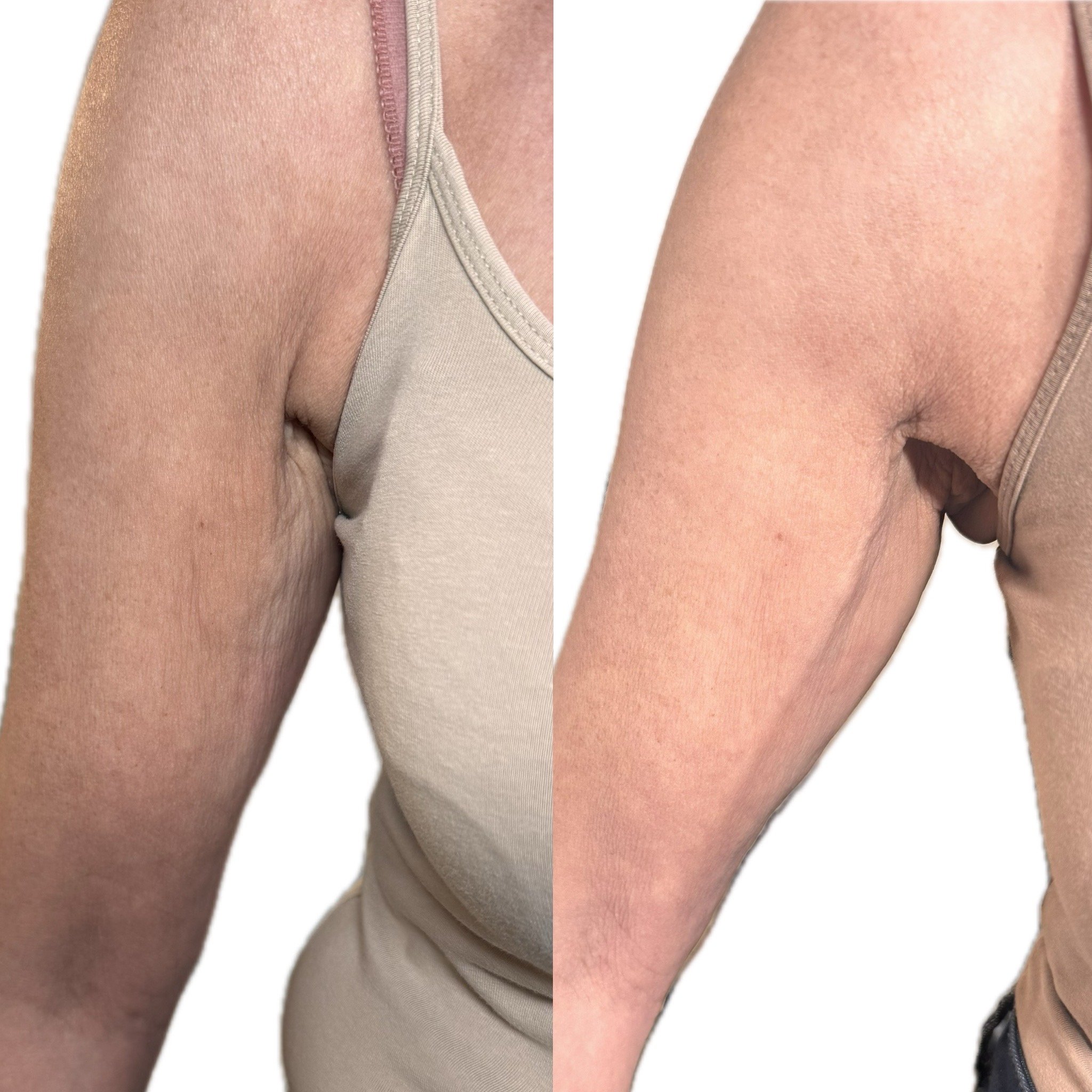 Comparison photo of upper arm skin, showing improvement in skin texture and firmness after treatment or skincare, with a beige tank top on the left and a beige tank top on the right.