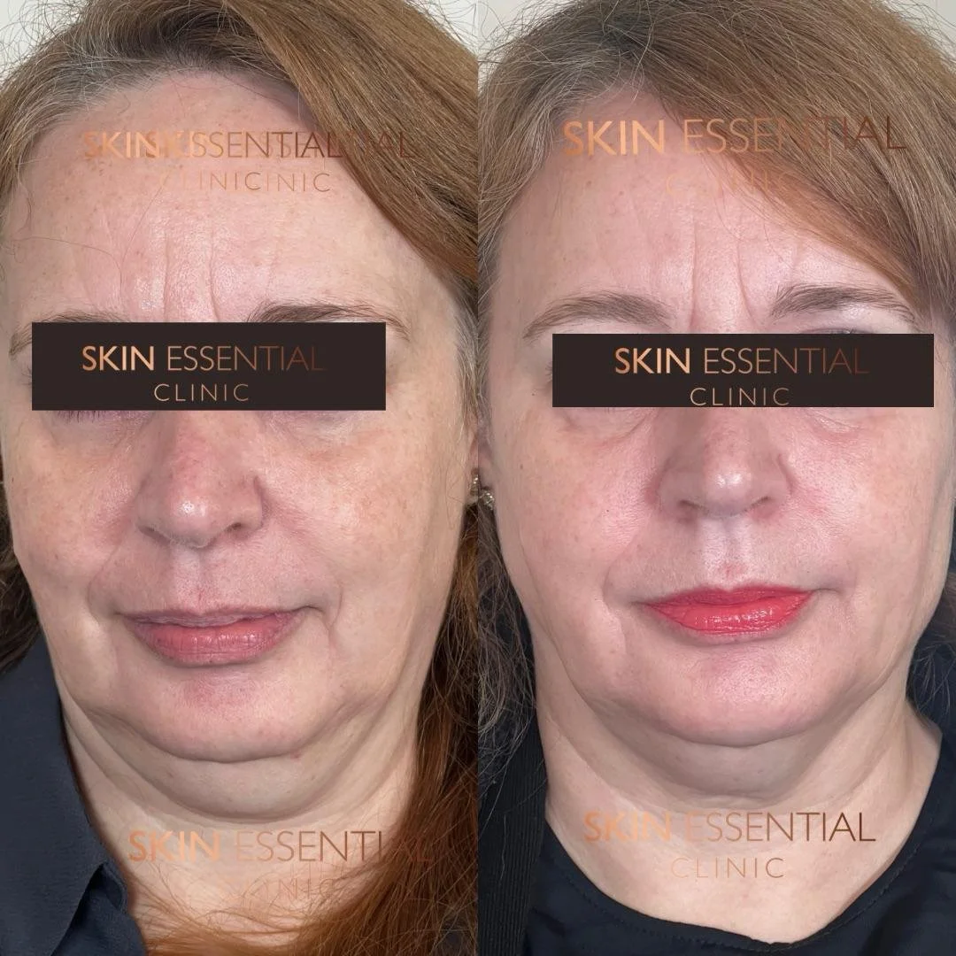 Side-by-side photos of a woman's face, showing before and after skin treatment, with the left image having clearer skin and the right image showing some redness and initial signs of improvement.