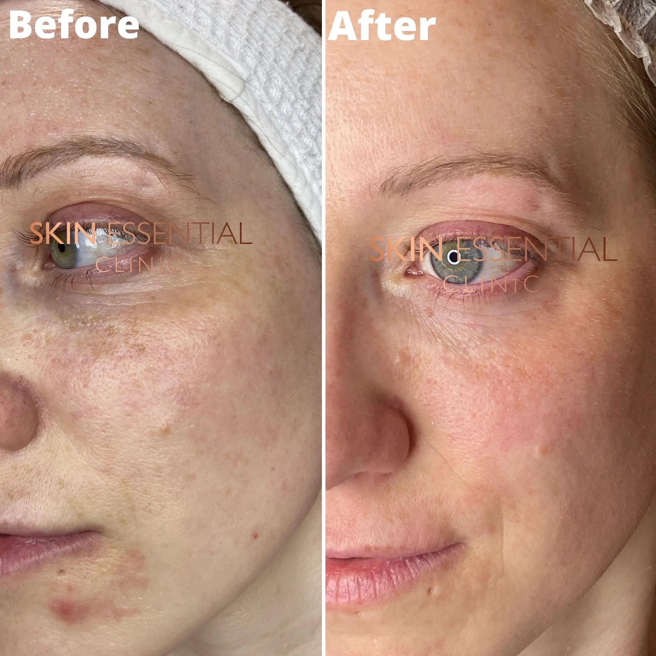Side-by-side comparison of a woman's face before and after skincare treatment, showing improved skin clarity and texture.