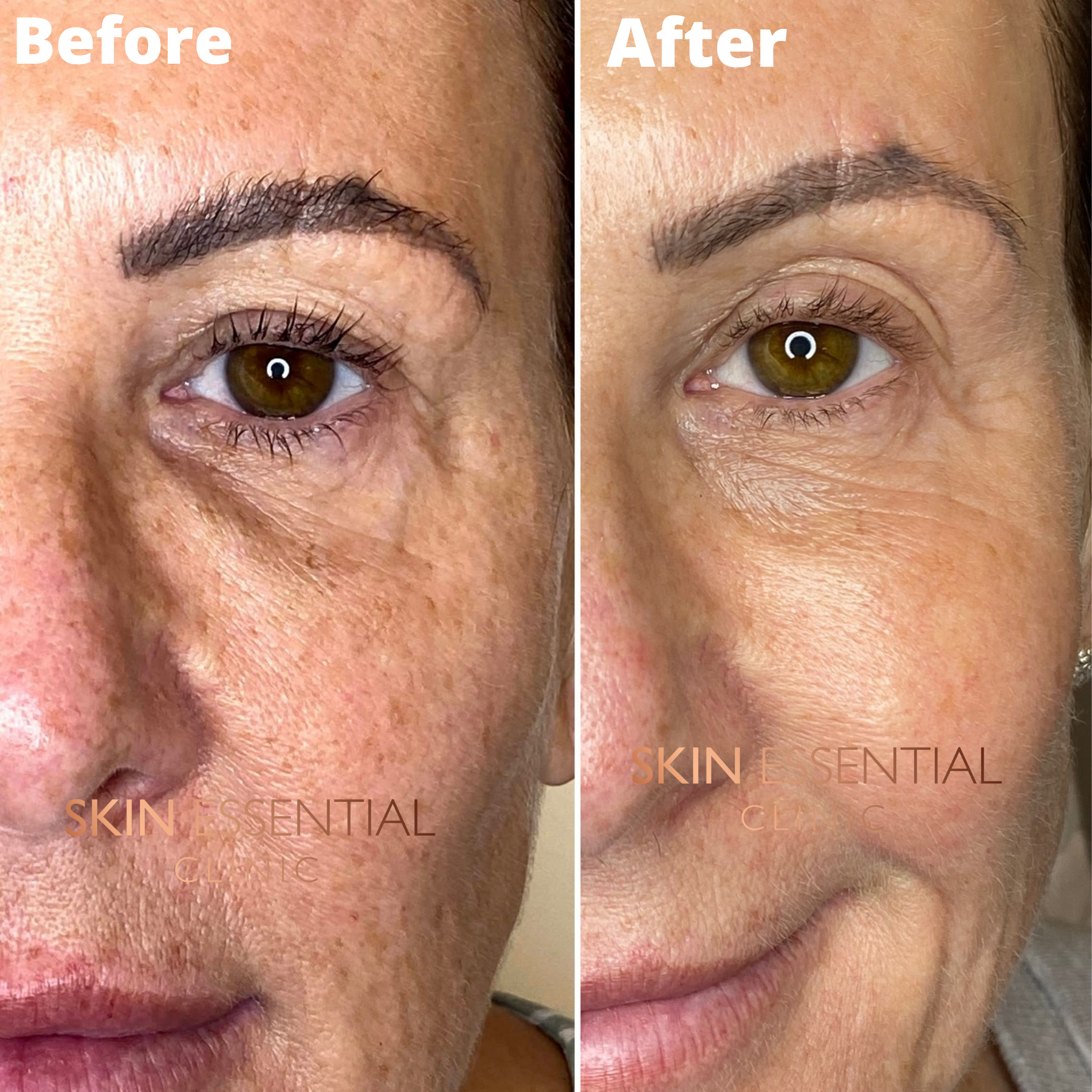 Side-by-side comparison of a woman's face showing the skin around her eye before and after a skin treatment, highlighting improved skin texture and reduced pigmentation.