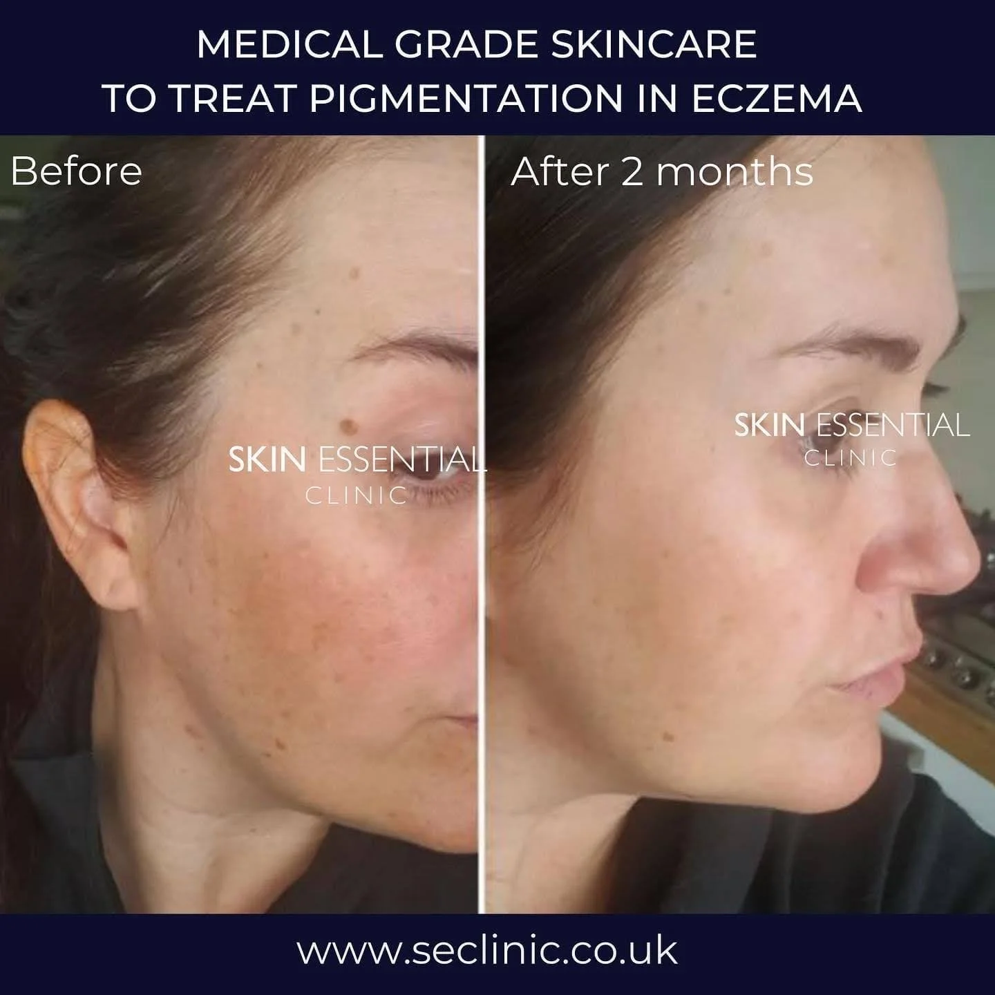 Side-by-side comparison of a woman's face before and after two months of skincare treatment for pigmentation in eczema, showing improved skin clarity.
