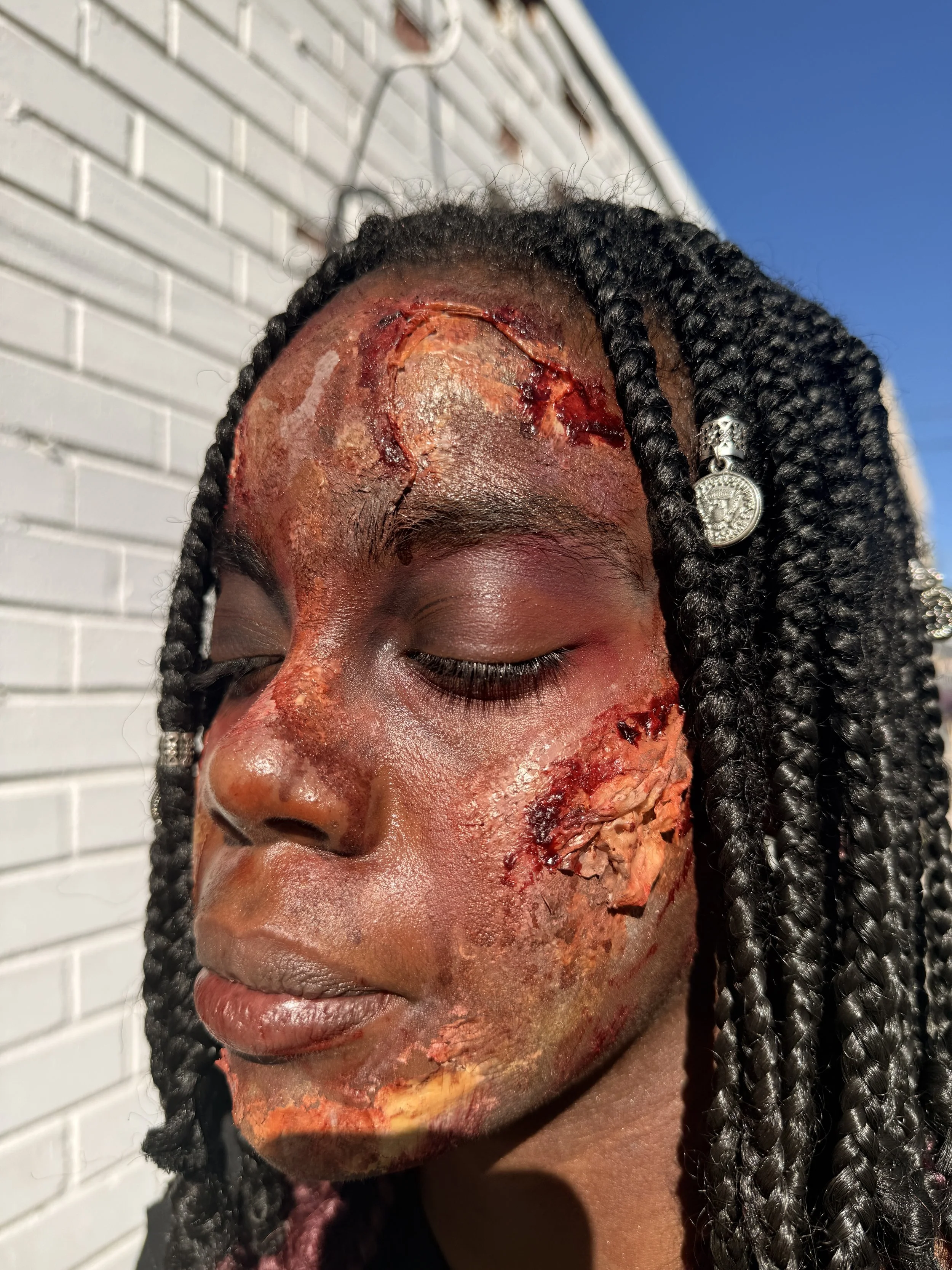Close-up of a young woman with braided hair and jewelry, with severe burns and injuries on her face, against a clear blue sky and white brick wall background.