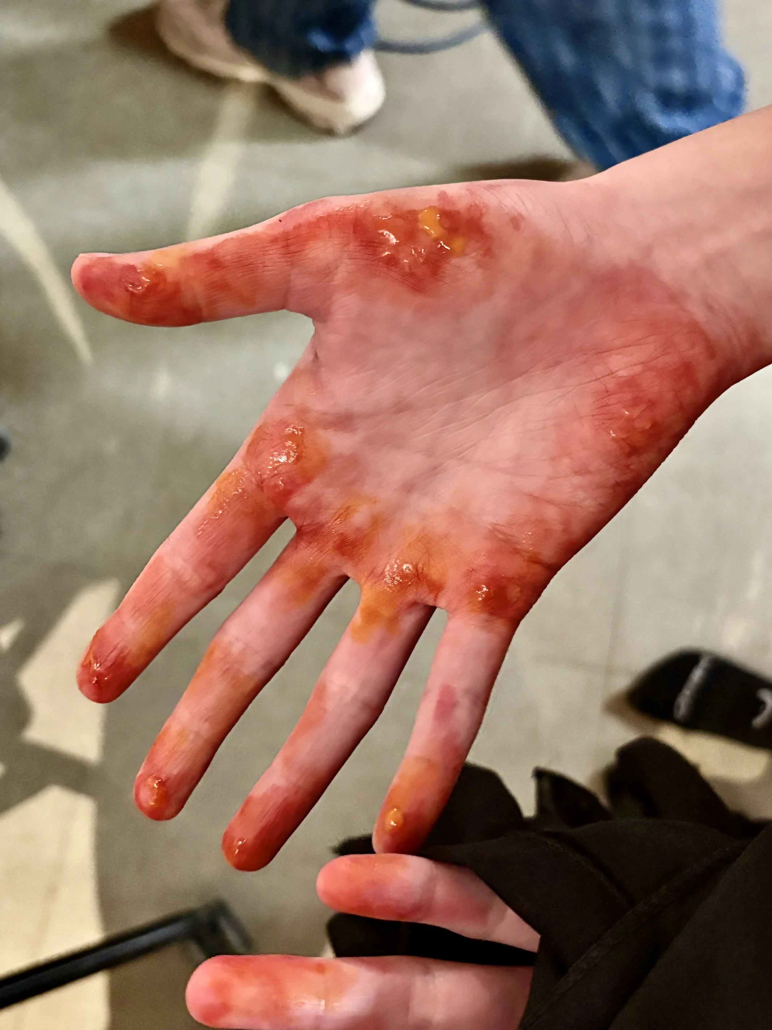 A person's hand with blisters, redness, and burns on fingers and palm.