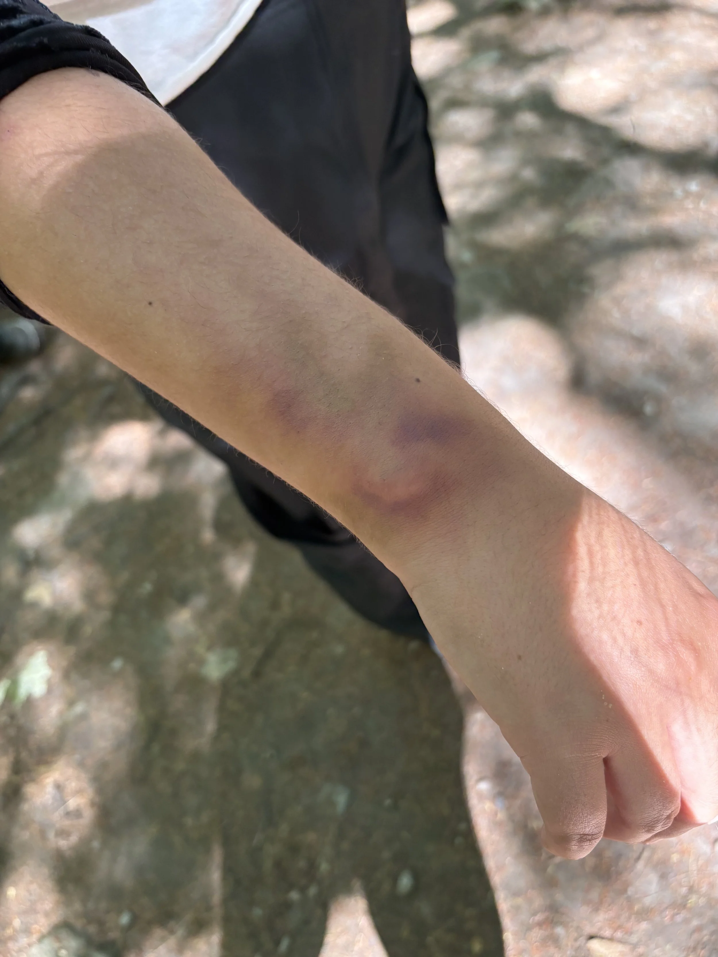The person's forearm with multiple bruises and scratches, with the background showing a ground surface.
