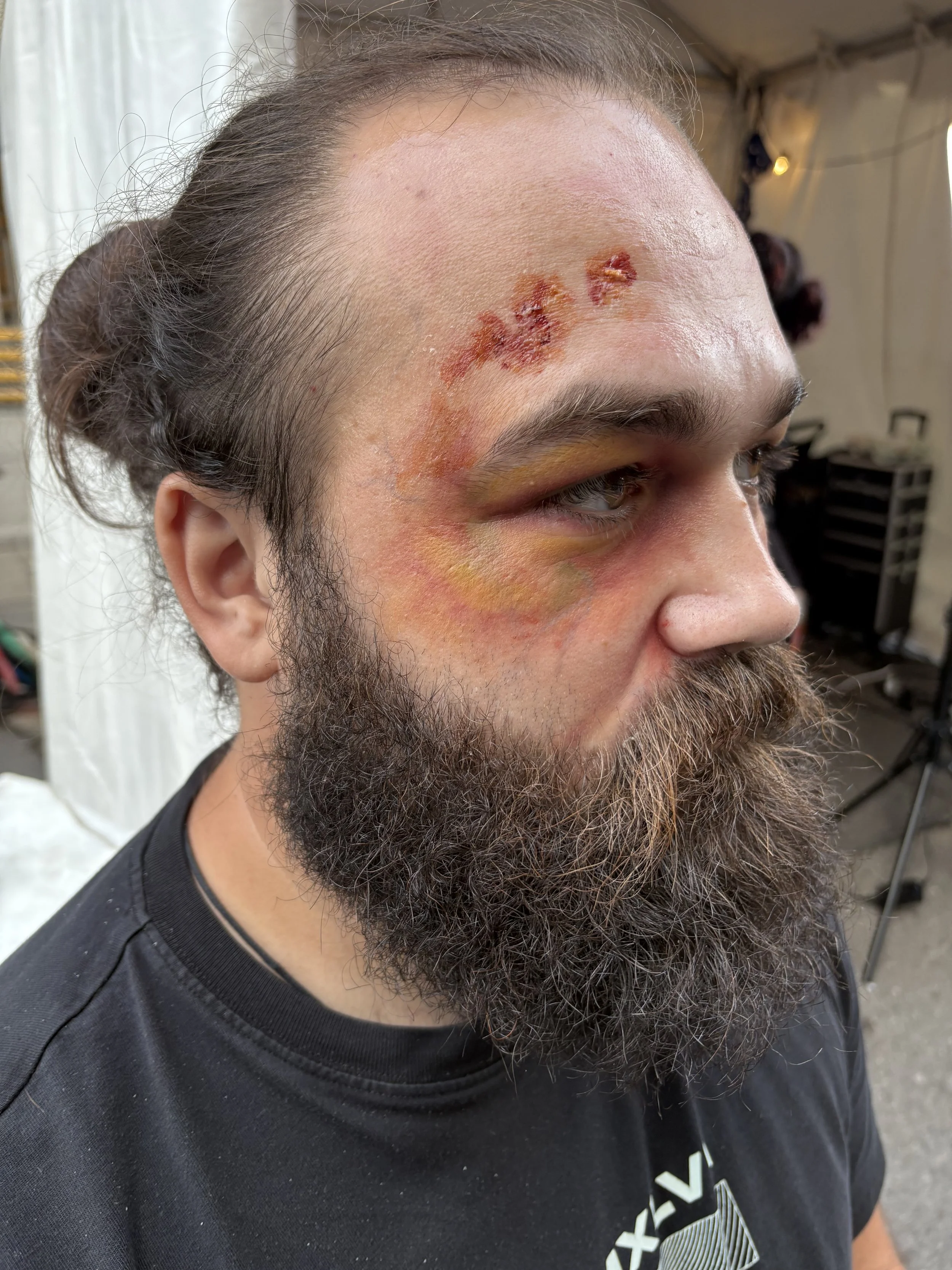 Man with a severe facial injury, including swollen eyes, bruising, and multiple lacerations on his forehead.