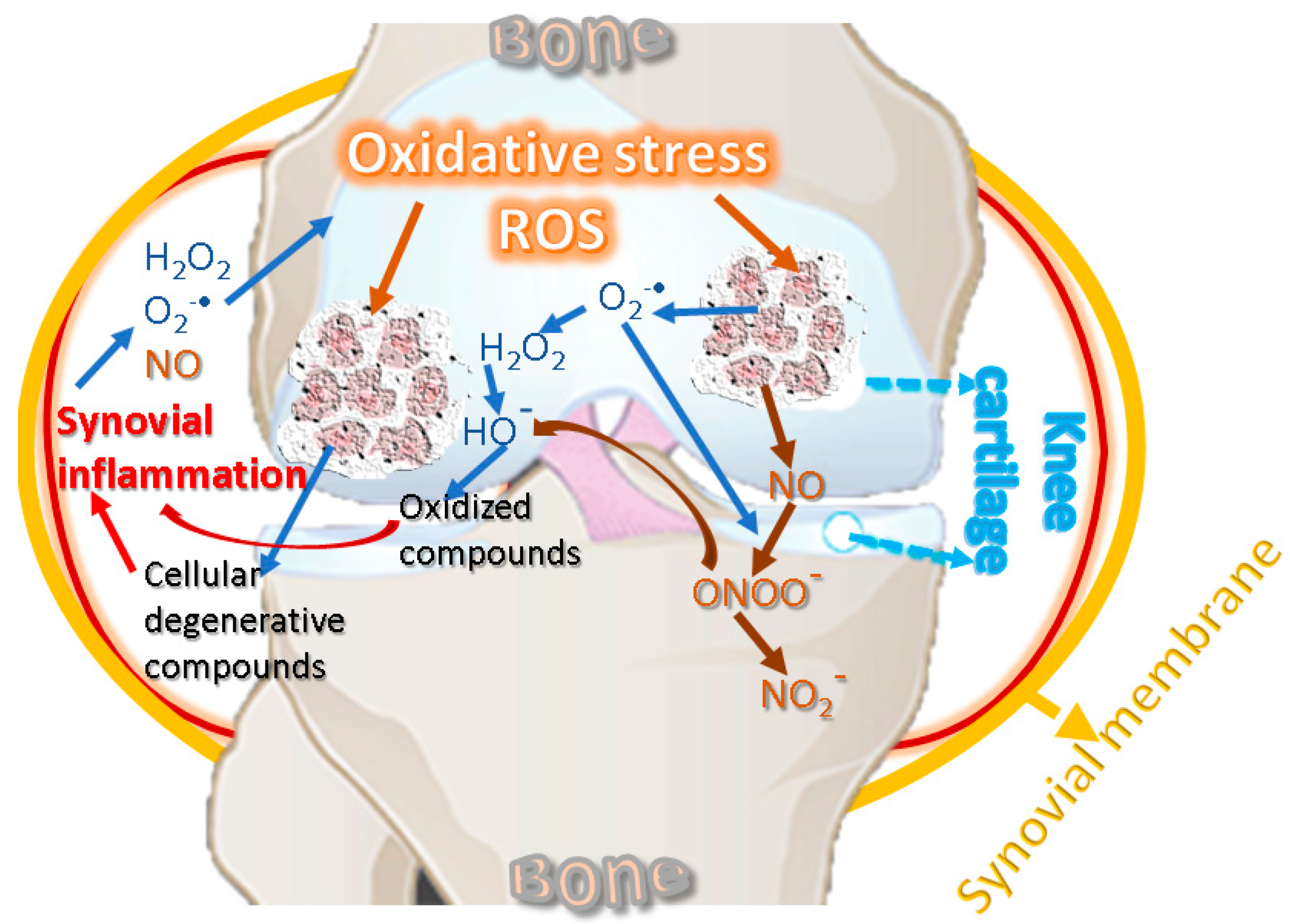 Movement and Inflammation: The Two Forces Driving Osteoarthritis