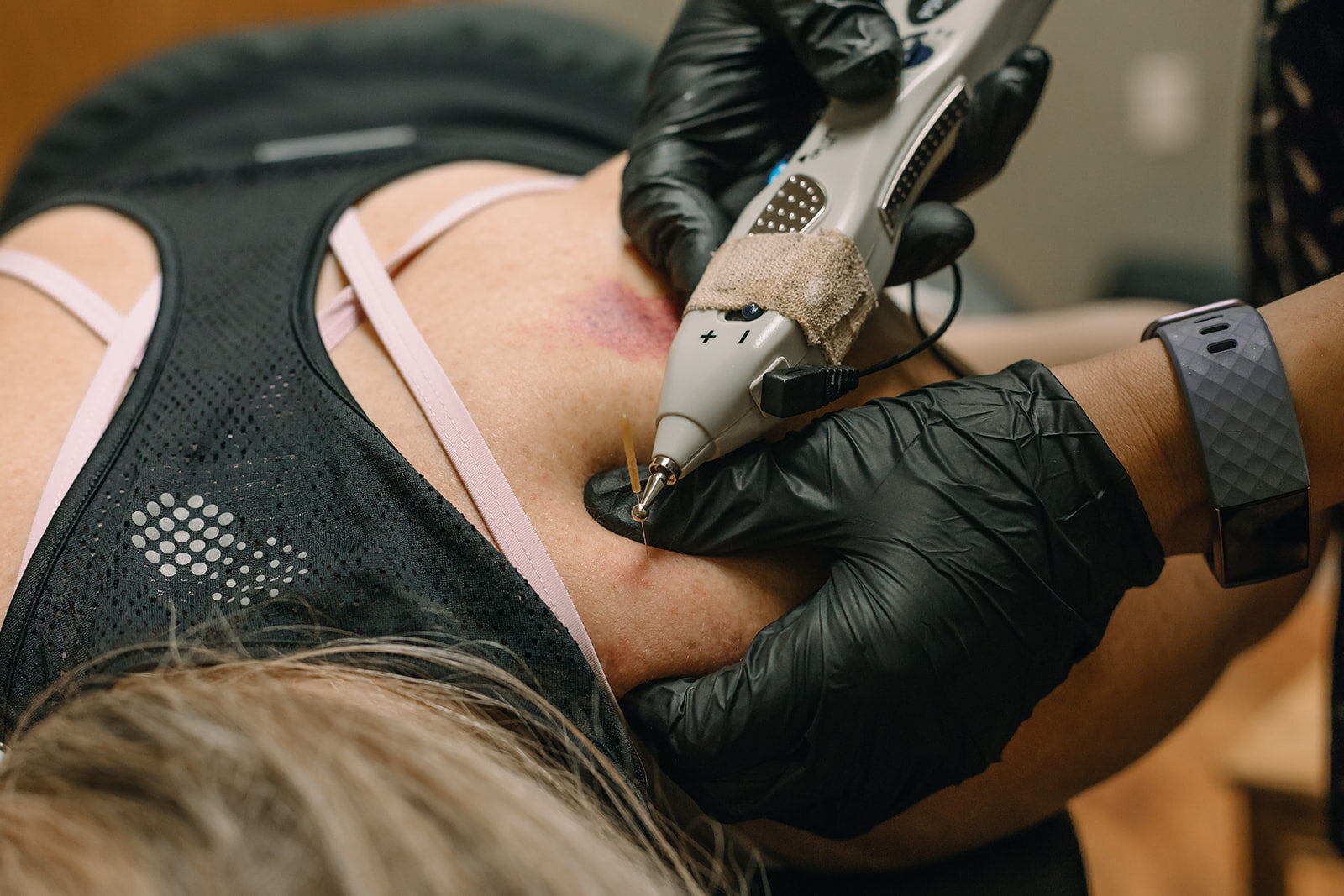 A person undergoing a skin biopsy procedure, with a healthcare professional using a medical device to extract a tissue sample from the patient's skin.