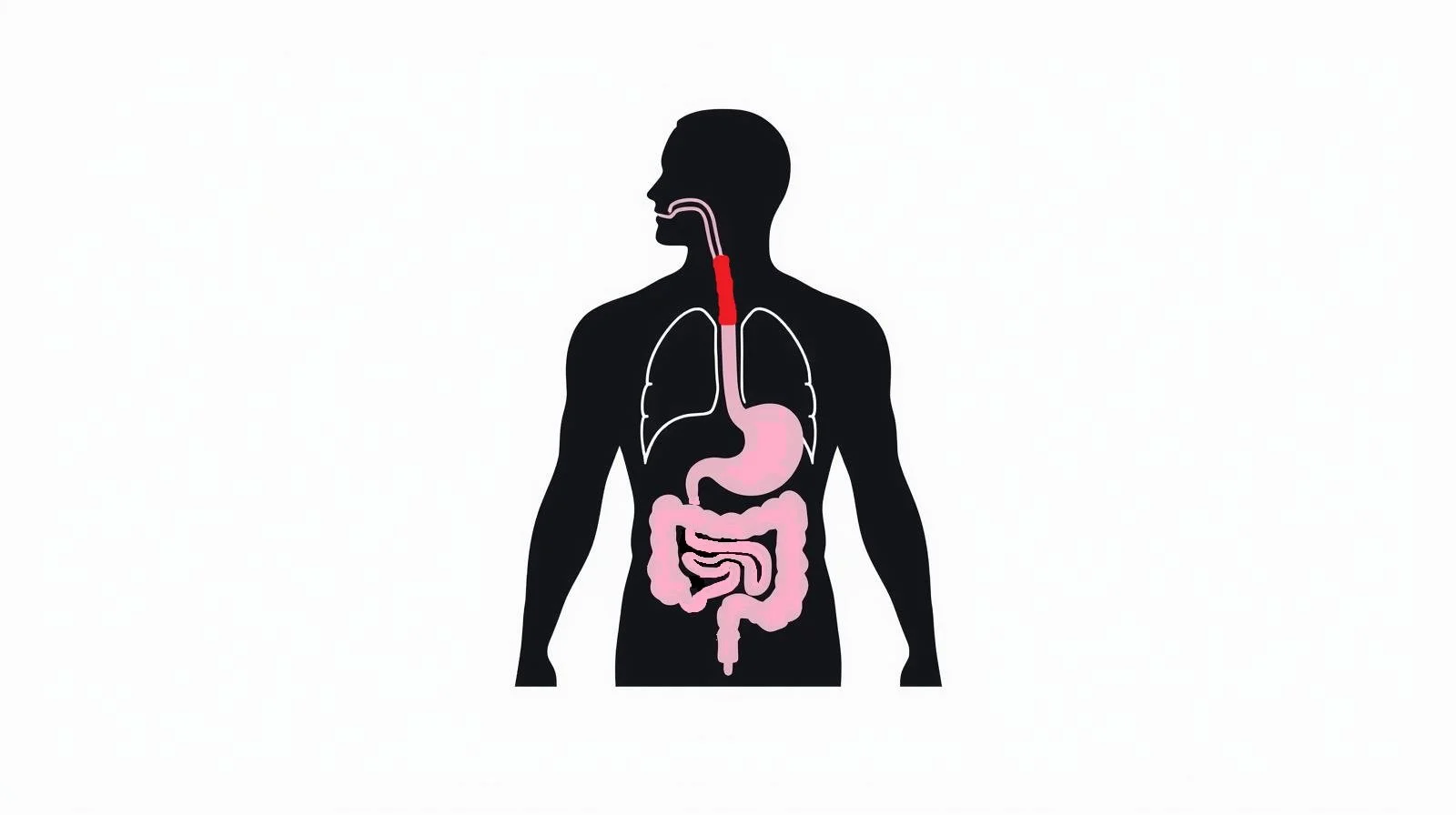 Esophagus Expansion Media