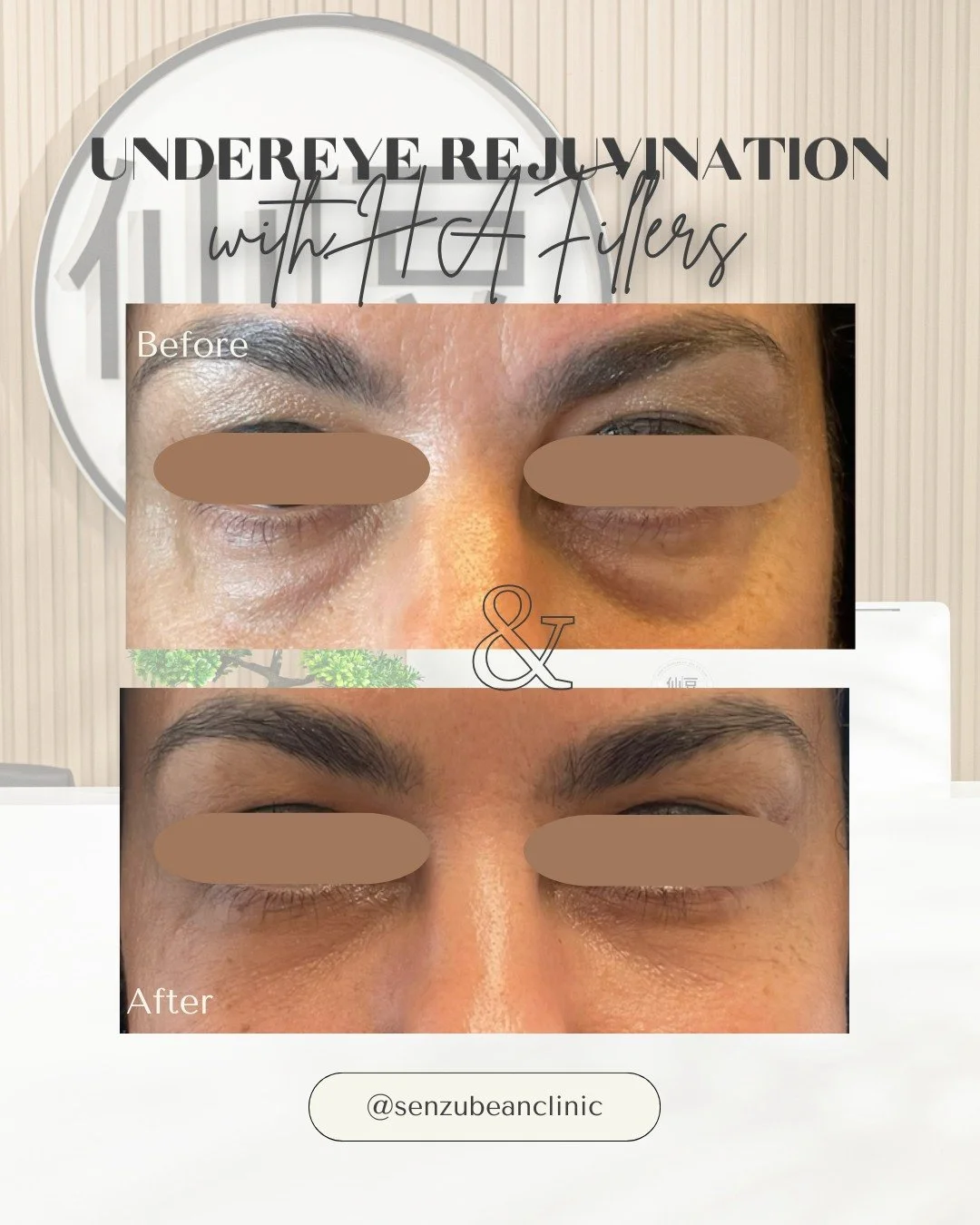 From Tired to Refreshed &mdash; Instantly 👀✨

When done correctly, it can:
&bull; soften dark circles and reduce shadowing
&bull; restore lost volume in hollow under-eyes
&bull; smooth the transition between the under-eye and cheek
&bull; create a b