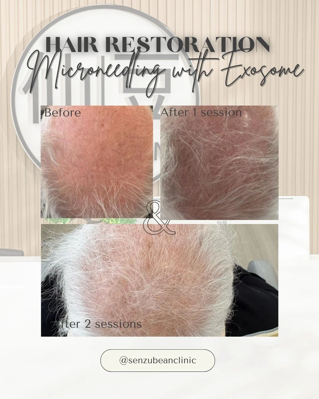 Hair restoration &mdash; powered by regeneration ✨

These results show the progression after 1 and 2 sessions of microneedling with exosomes &mdash; a powerful combination designed to support hair growth at the root level.

This treatment works by:
&