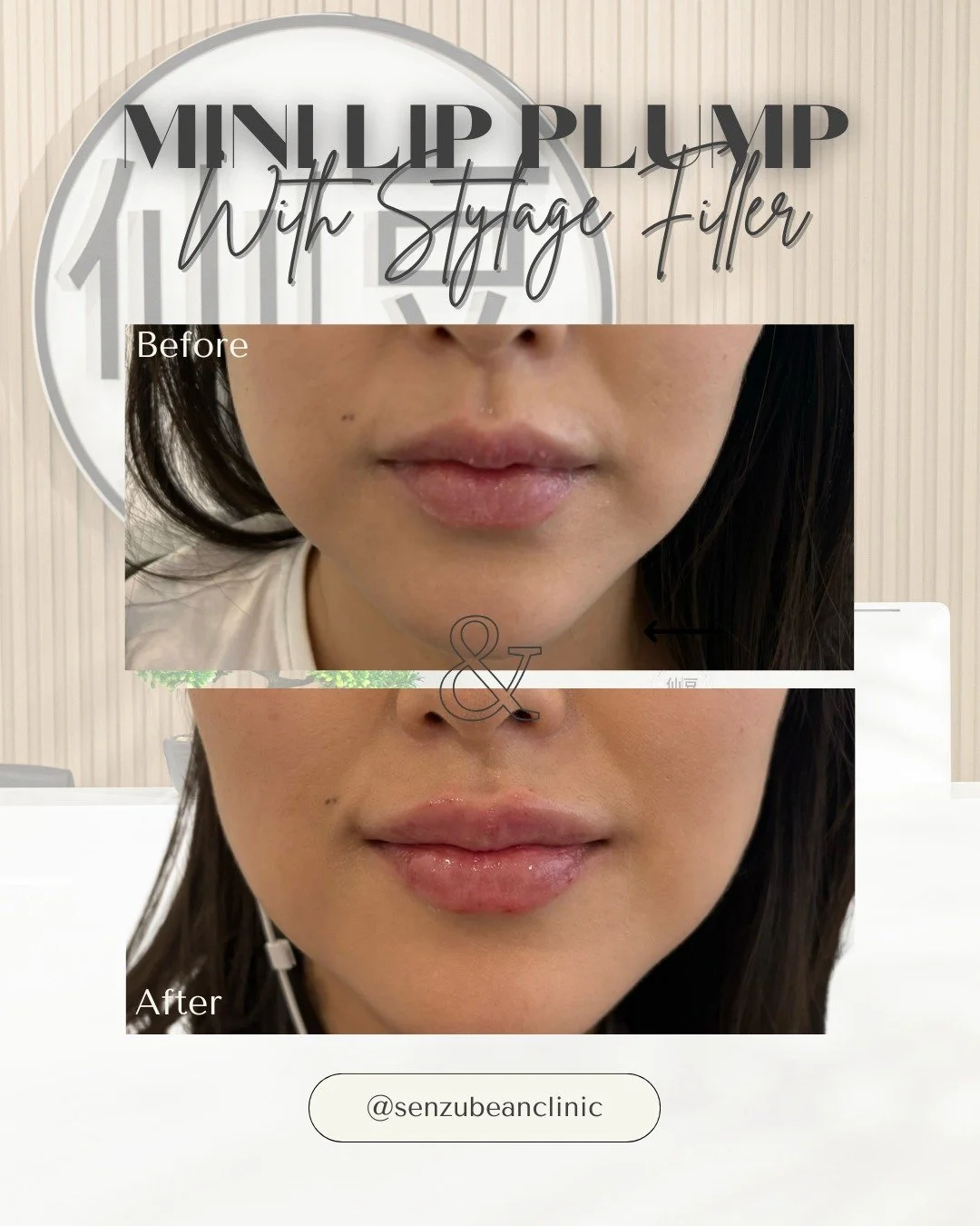A little volume&hellip; a lot of difference 💋✨

This mini lip plump with Stylage filler is all about enhancing &mdash; not overfilling.

While lip filler is often associated with volume, the real magic is in how it can:
&bull; smooth out fine lines 