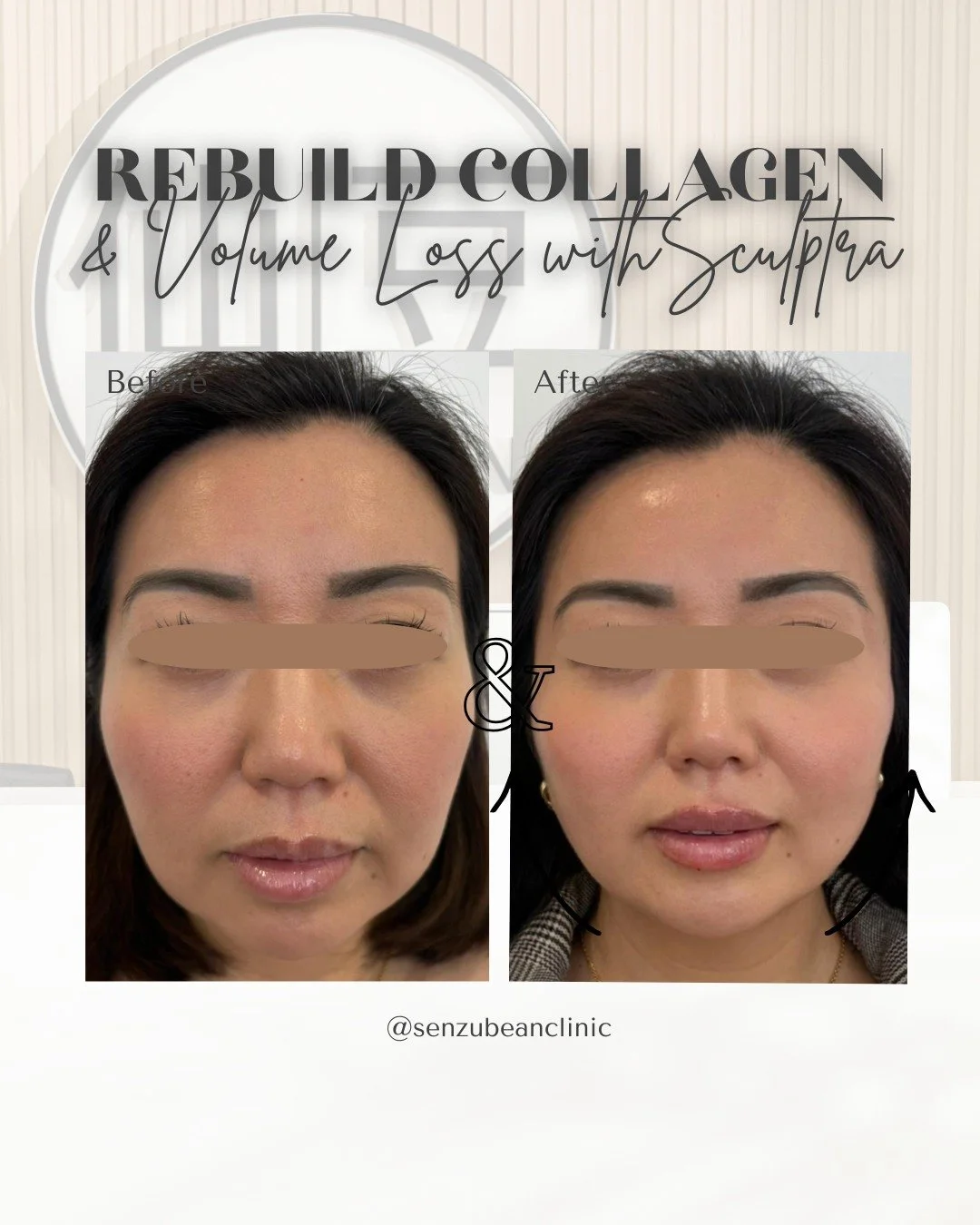 This isn&rsquo;t filler&hellip; it&rsquo;s a collagen comeback ✨

Our client wanted to restore volume loss &mdash; but keep things looking completely natural 🤍 No drastic change, no &ldquo;overdone&rdquo; look.

That&rsquo;s why we chose Sculptra &m
