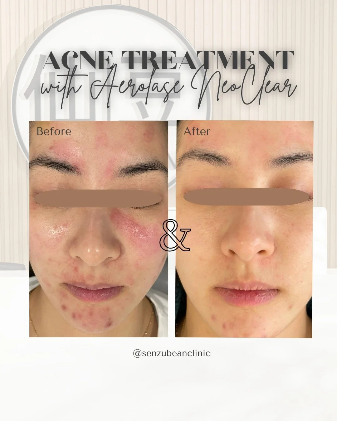 Our Secret to Treating Acne 👇✨

Our client came to us wanting to improve active breakouts, redness, and overall skin clarity while keeping her treatment gentle on the skin 🤍

We chose the Aerolase NeoClear laser because it&rsquo;s one of the most e