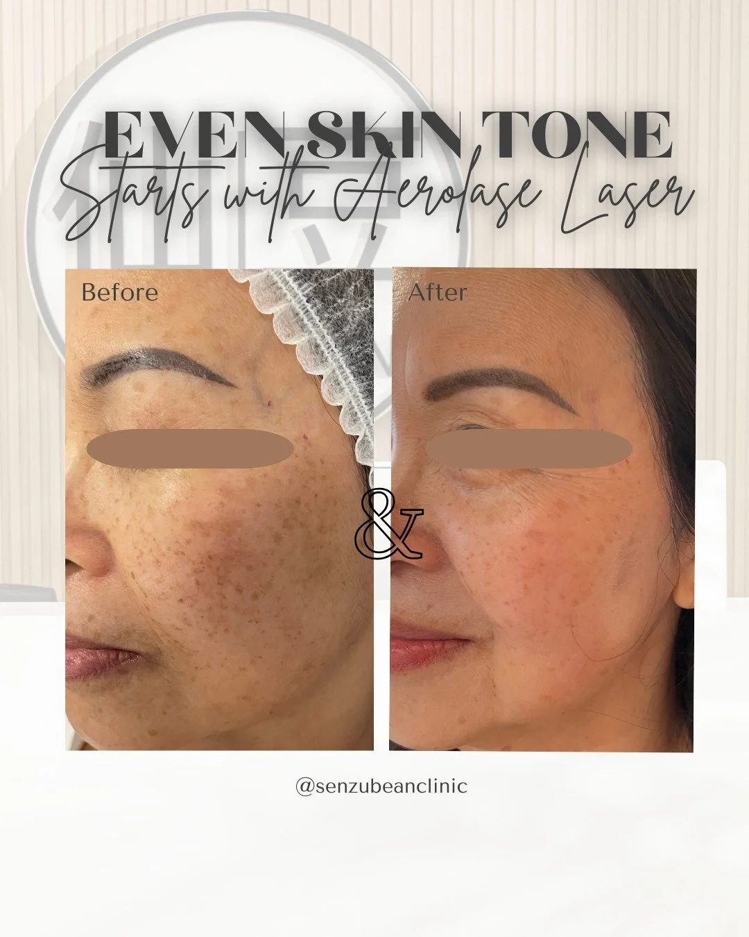 Treating uneven skin tone at the source ✨

Aerolase NeoSkin Laser is one of the most advanced treatments for pigmentation because it works deep within the skin to break up excess melanin, reduce inflammation, and restore a clearer, more even complexi