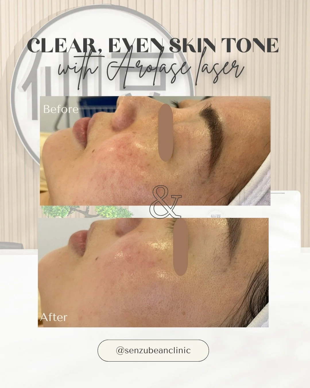 Clear, even skin tone starts with Aerolase Laser Treatment ✨

Our client was looking for a gentle yet effective solution to even out her skin tone and reduce visible pigmentation &mdash; without harsh treatments or downtime

We chose Aerolase NeoSkin