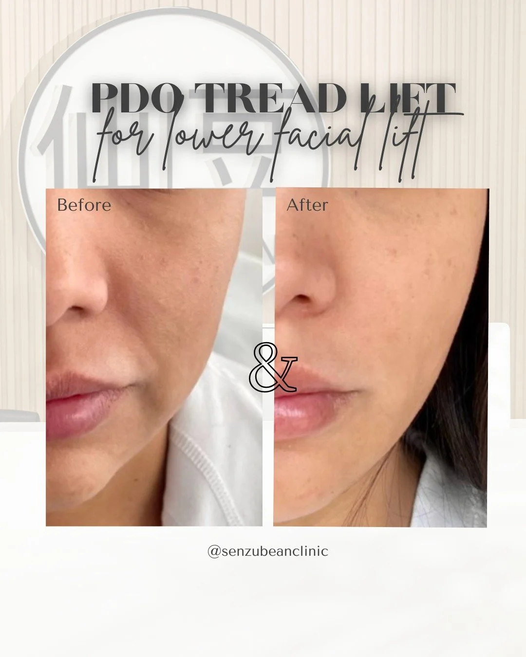 Subtle lift. Real results ✨

PDO thread lifts are designed to reposition and support the skin, creating a naturally lifted, more contoured appearance &mdash; without surgery 💁&zwj;♀️

In this transformation, you can see how the treatment helps to:
&
