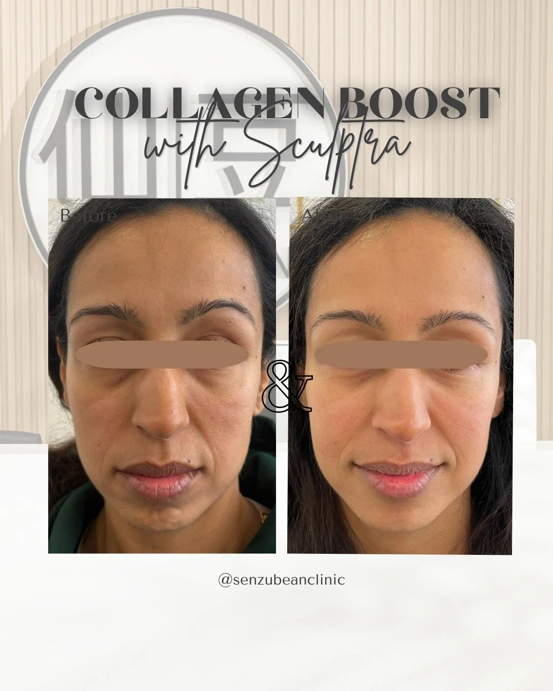 Our fave treatment for long-lasting collagen ✨

Our client wanted a treatment that would restore volume, improve skin quality, and boost collagen &mdash; while still looking completely natural 💁&zwj;♀️

We opted for Sculptra, a collagen biostimulato