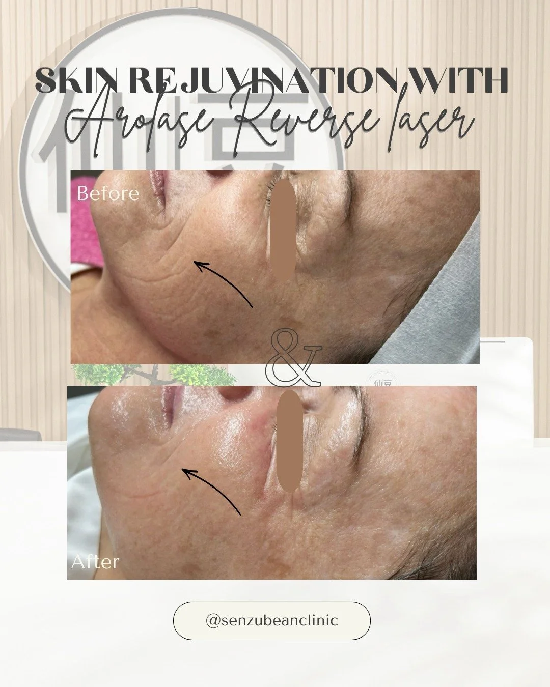 Want to know our recommended treatment for skin rejuvenation? 👇✨

One of our favourite treatments for brighter, smoother, healthier-looking skin is the Aerolase Reverse treatment 🤍

This treatment combines the power of the Neo + Era lasers to rejuv