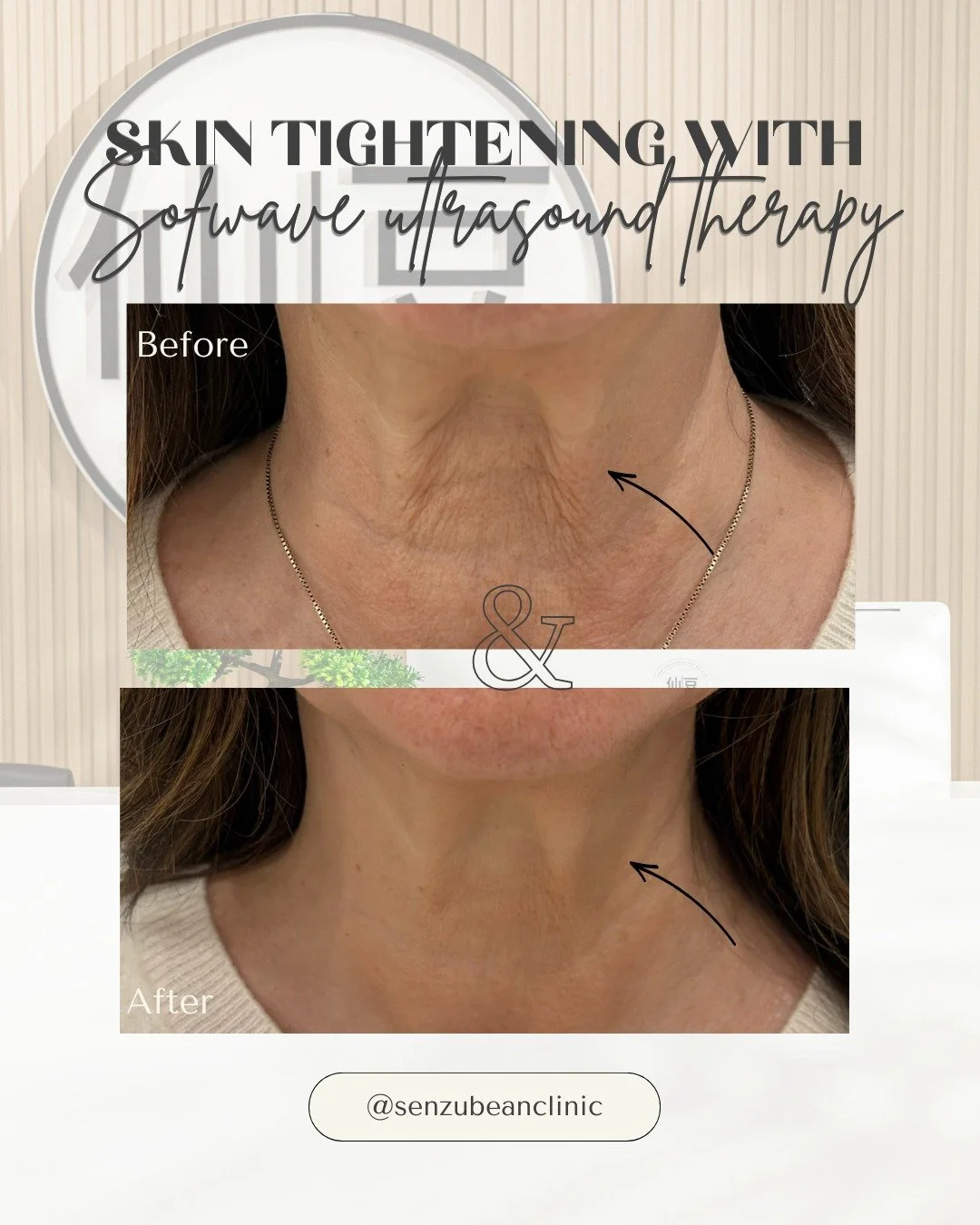 Skin tightening doesn't have to be ONLY for the face ✨

One of the reasons we love Sofwave Ultrasound Therapy is that it stimulates your body's natural collagen production to create firmer, tighter, and more youthful-looking skin&mdash;without surger