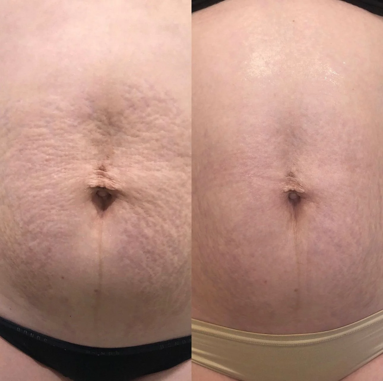 2 Sessions - Inkless Stretchmark Revision