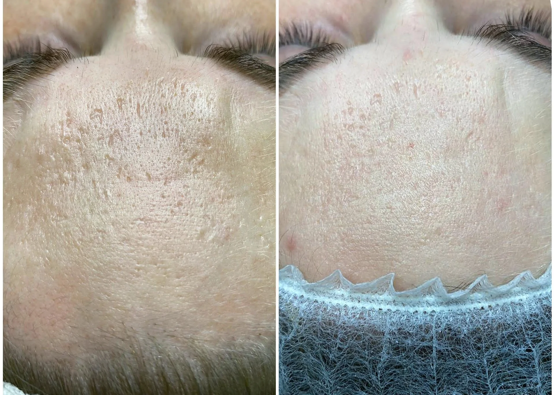 Acne Scarring