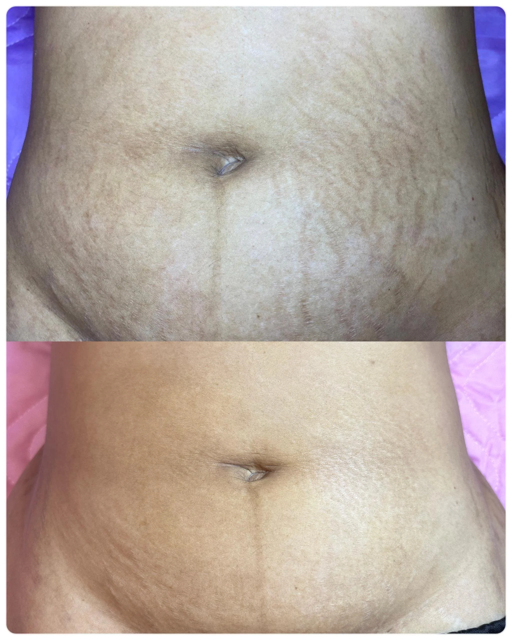 2 Sessions - Inkless Stretchmark Revision