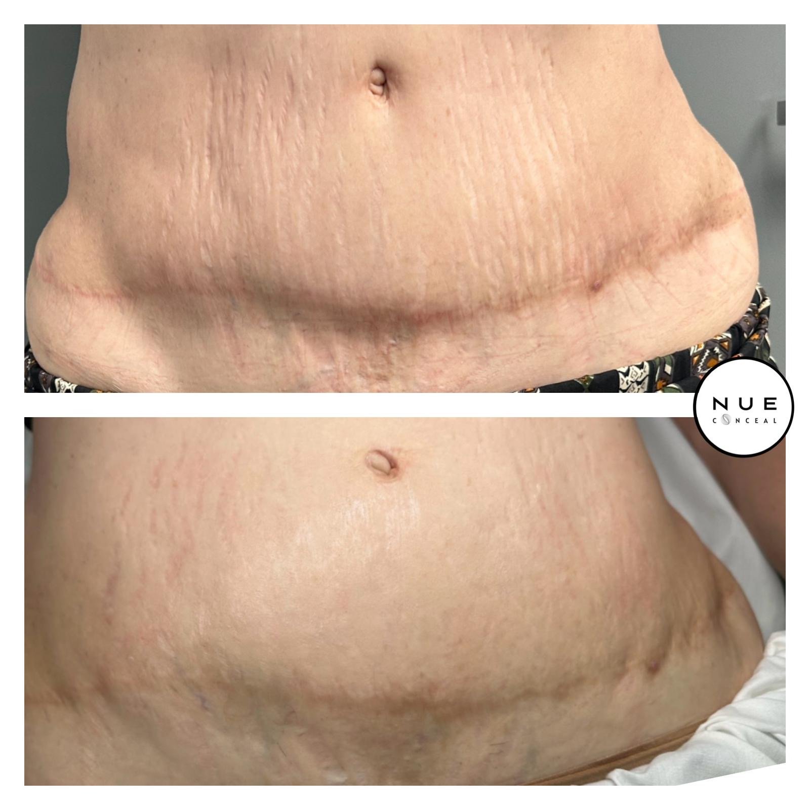1 Session - Inkless Scar Revision - Tummy Tuck