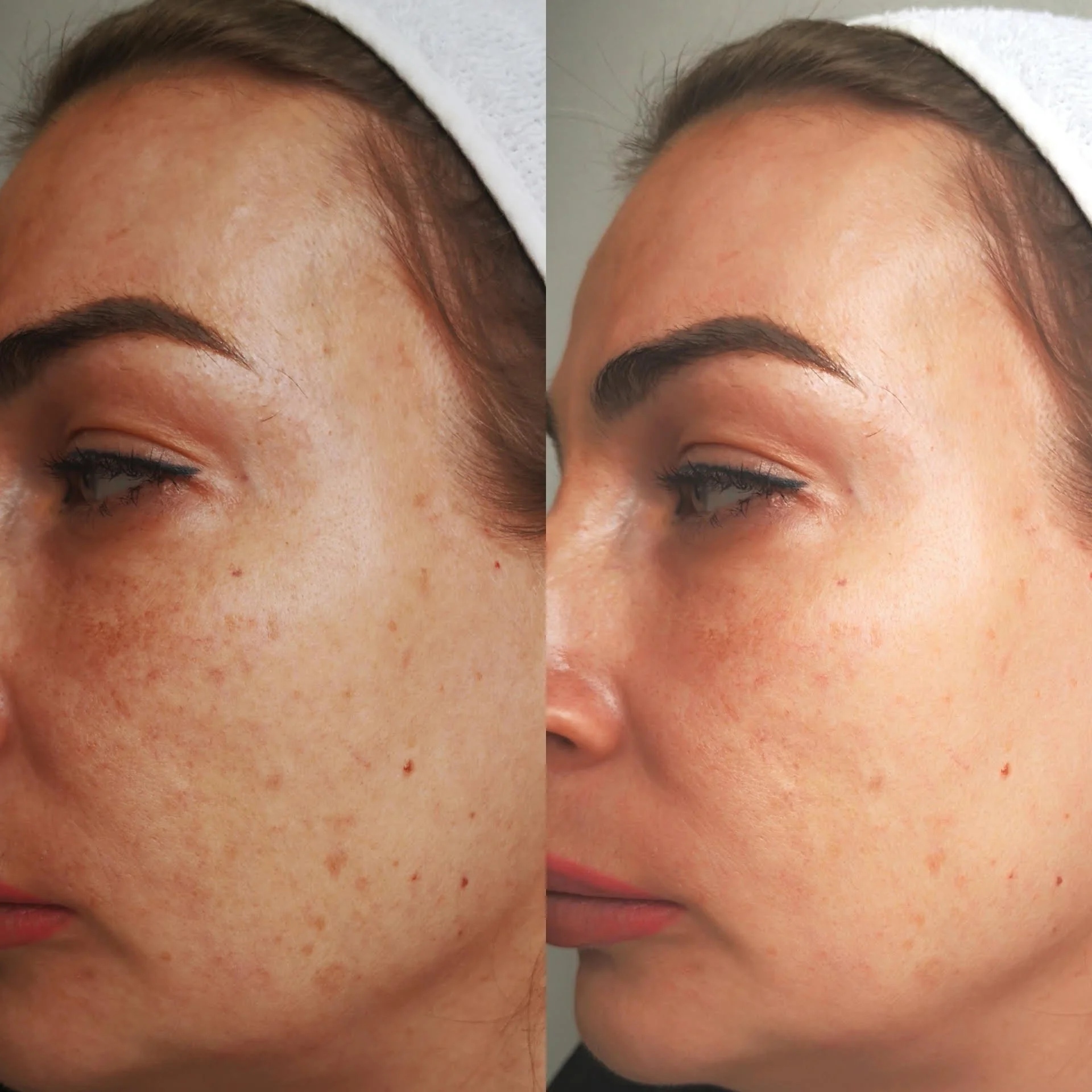 Pigmentation/Skin Tone
