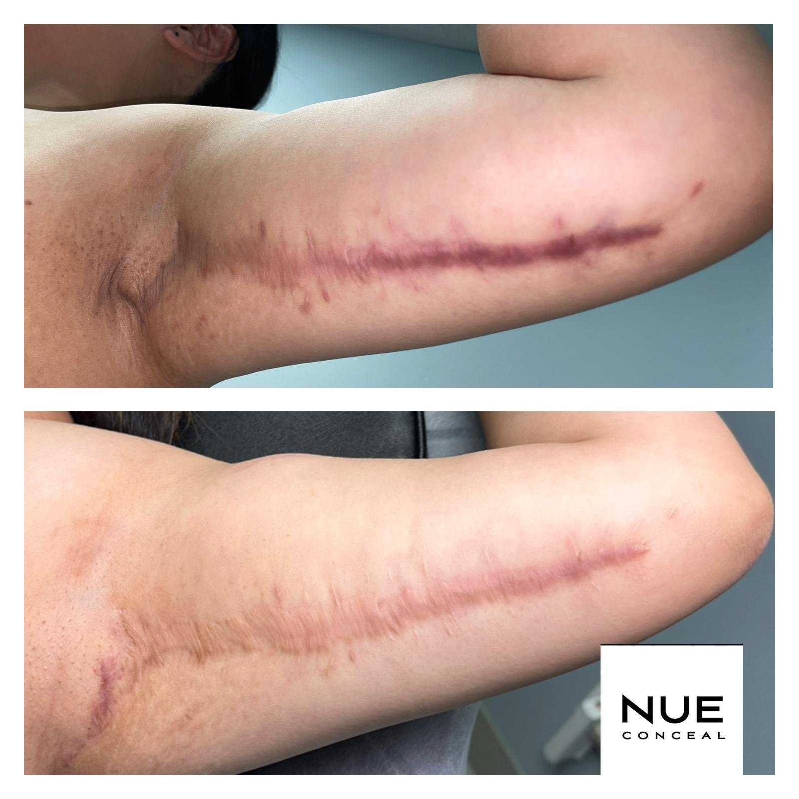 1 Session - Inkless Scar Revision