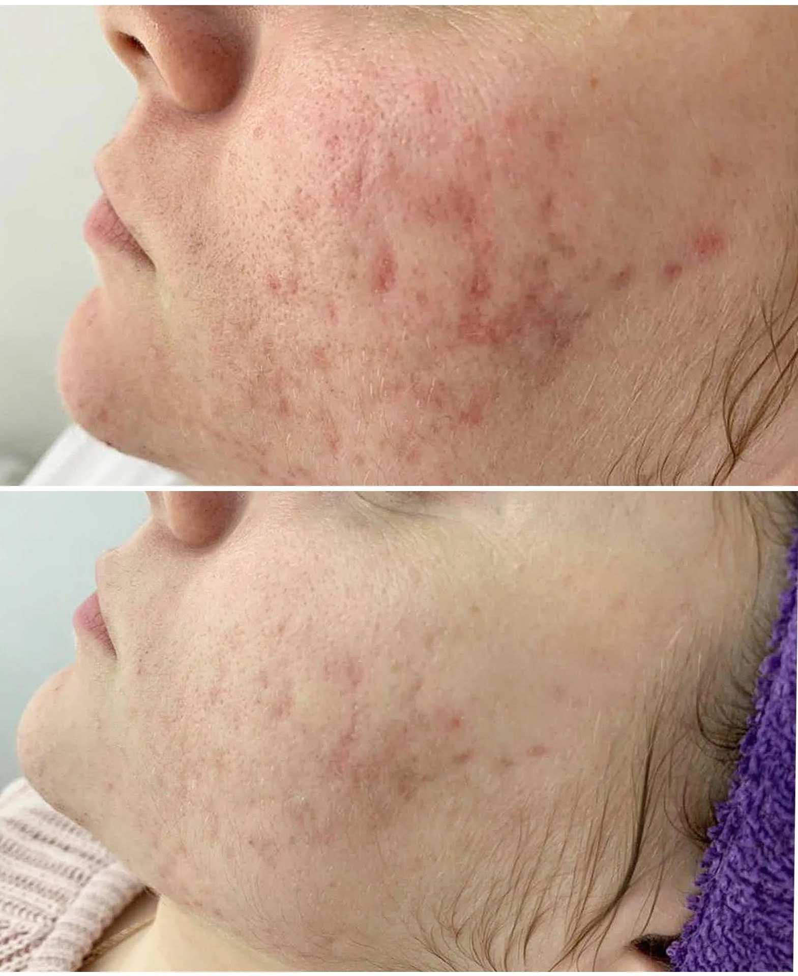 Acne Scarring