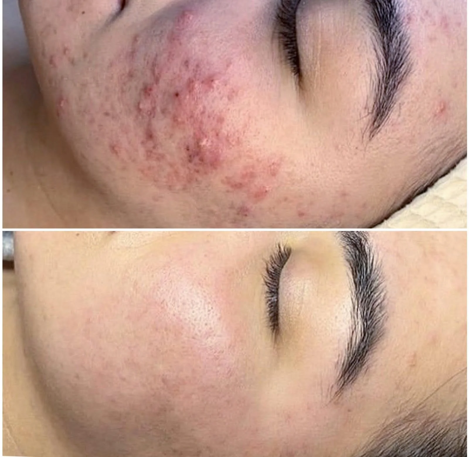 Acne