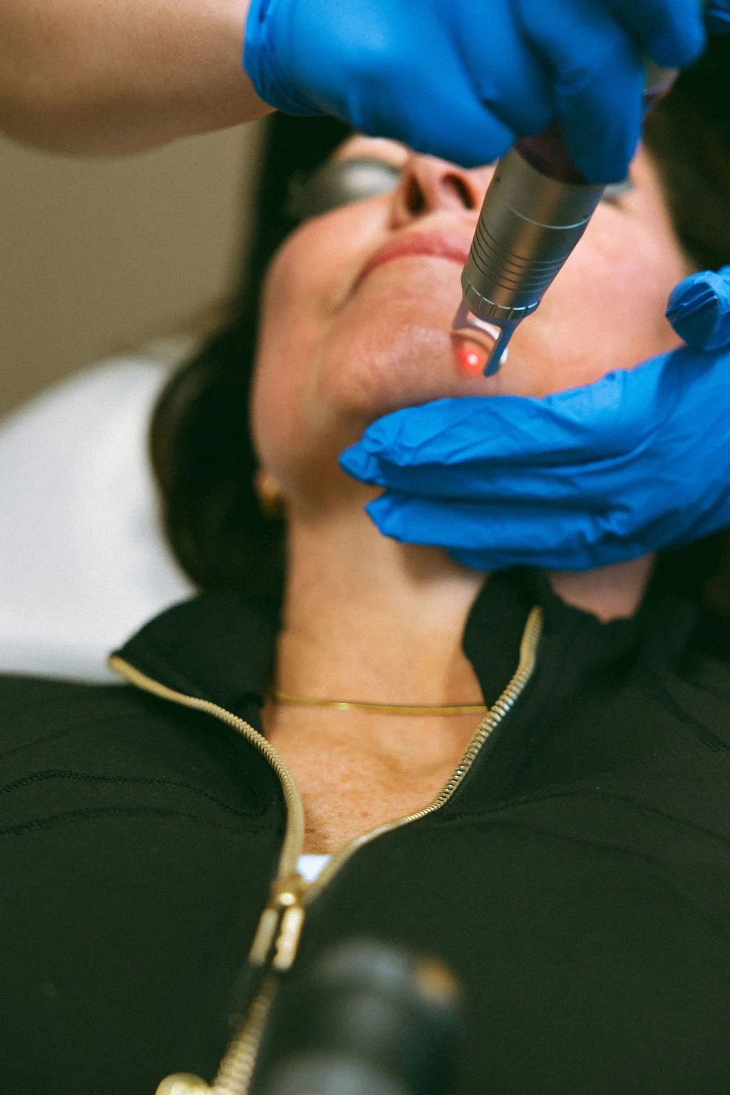 A woman receiving a laser skin treatment on her chin from a healthcare professional wearing blue gloves.