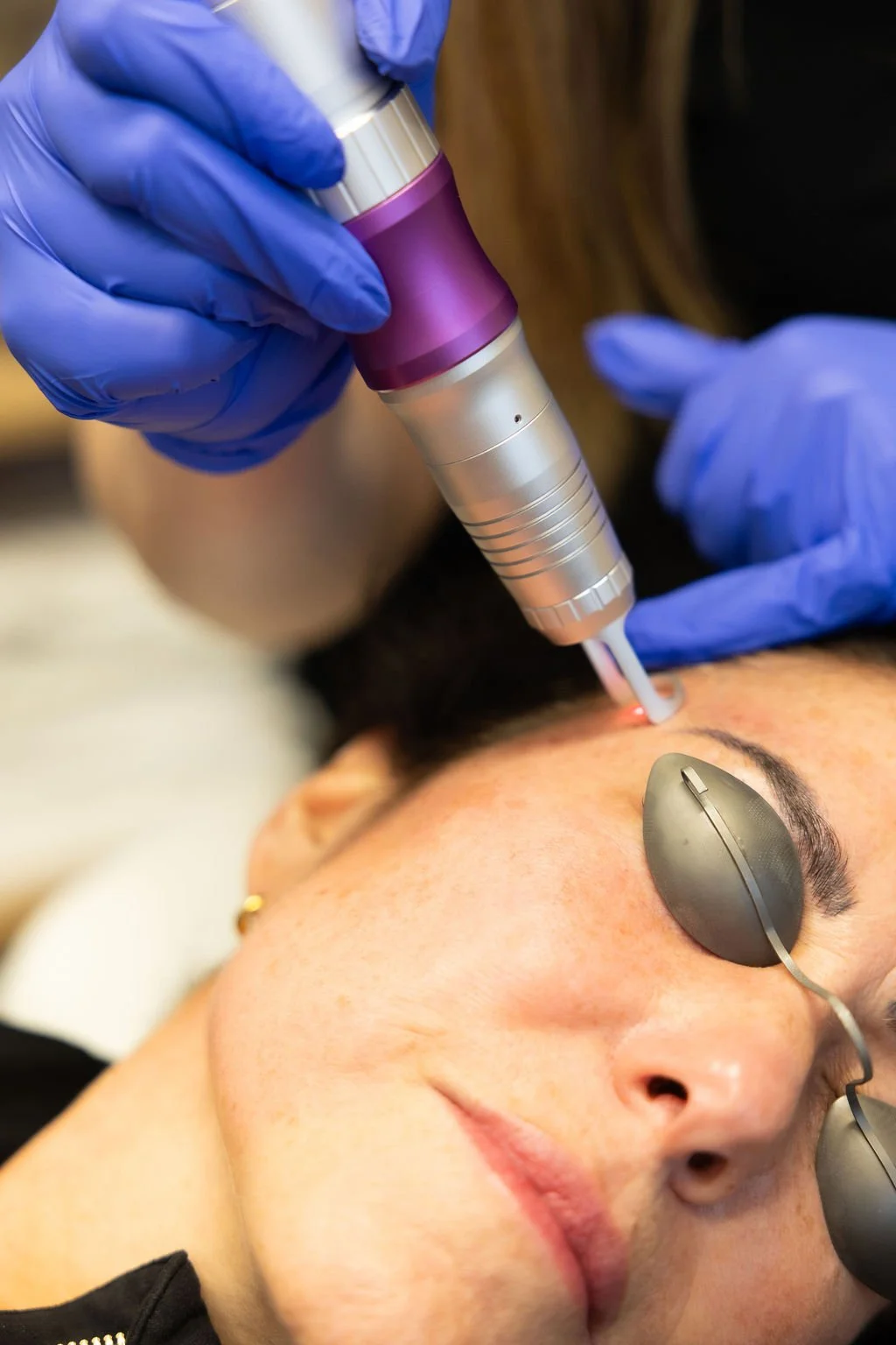 A person receiving a cosmetic or dermatological treatment on their face with a handheld device, wearing goggles, and a medical professional wearing blue gloves operating the device.