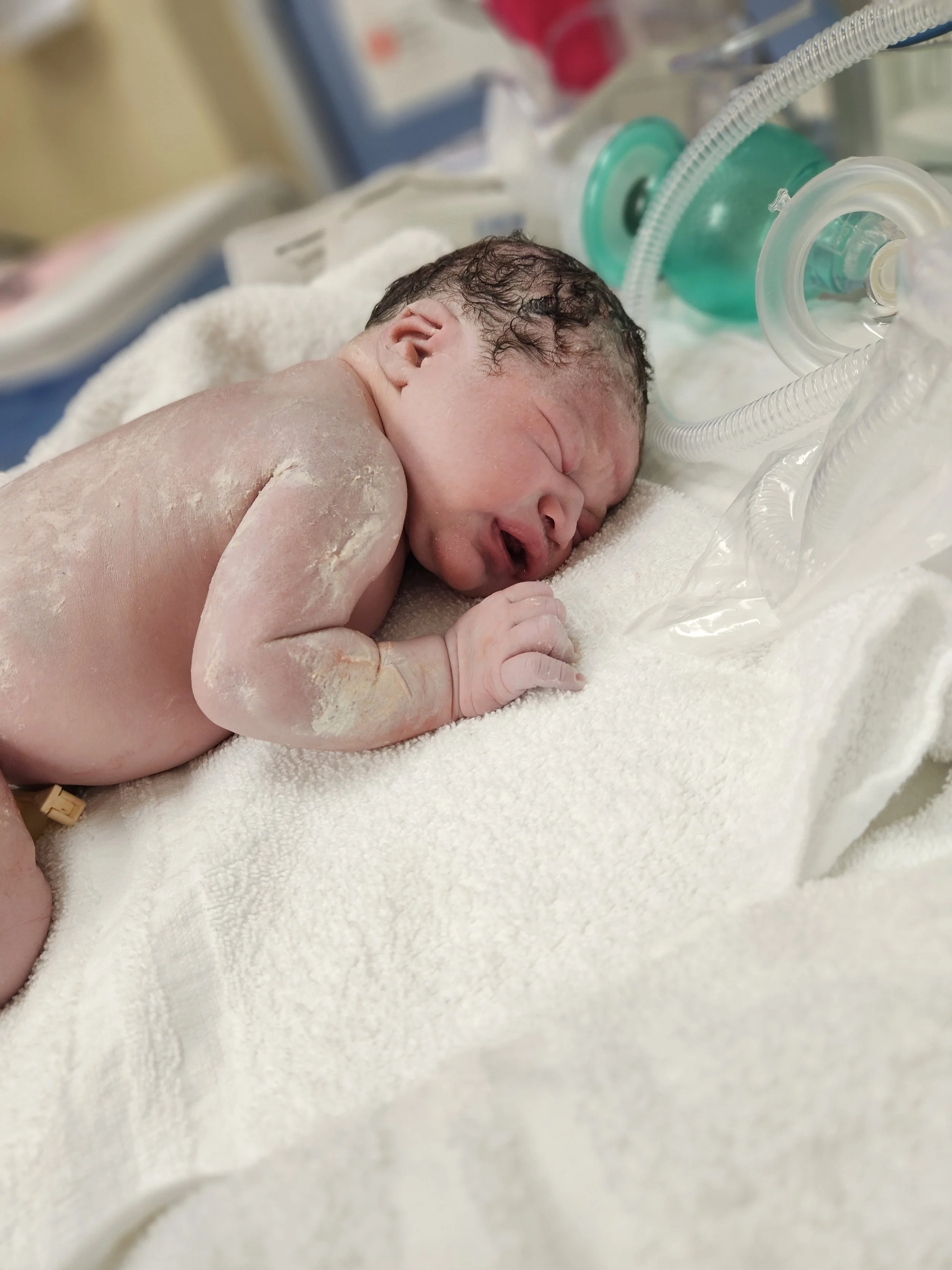 Newborn baby lying on a blanket in a neonatal intensive care unit, connected to medical equipment, with a slightly distressed expression.