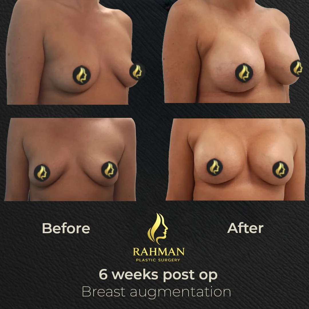 6 Week Breast Aug 2.jpg