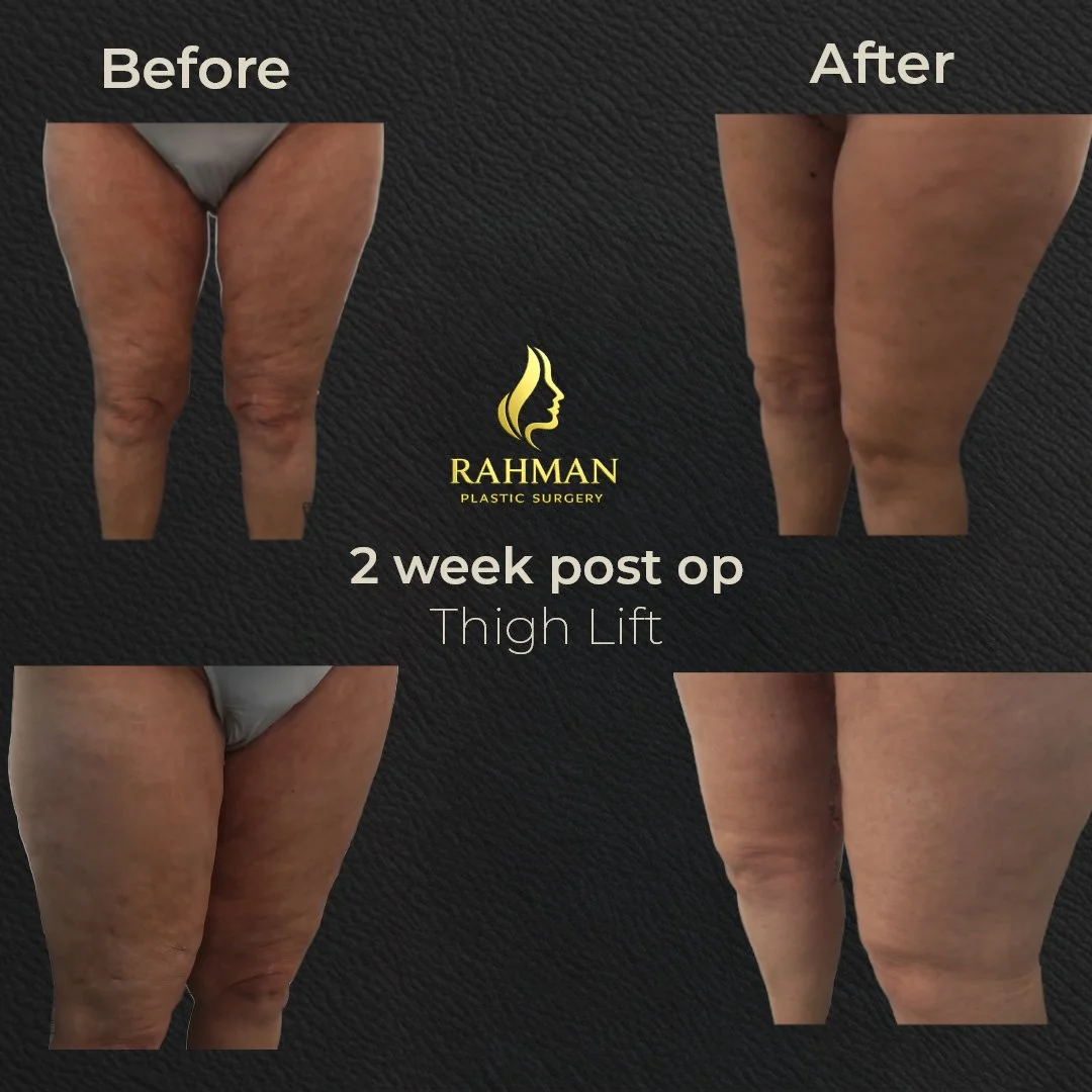 2 week Thigh Lift.jpg
