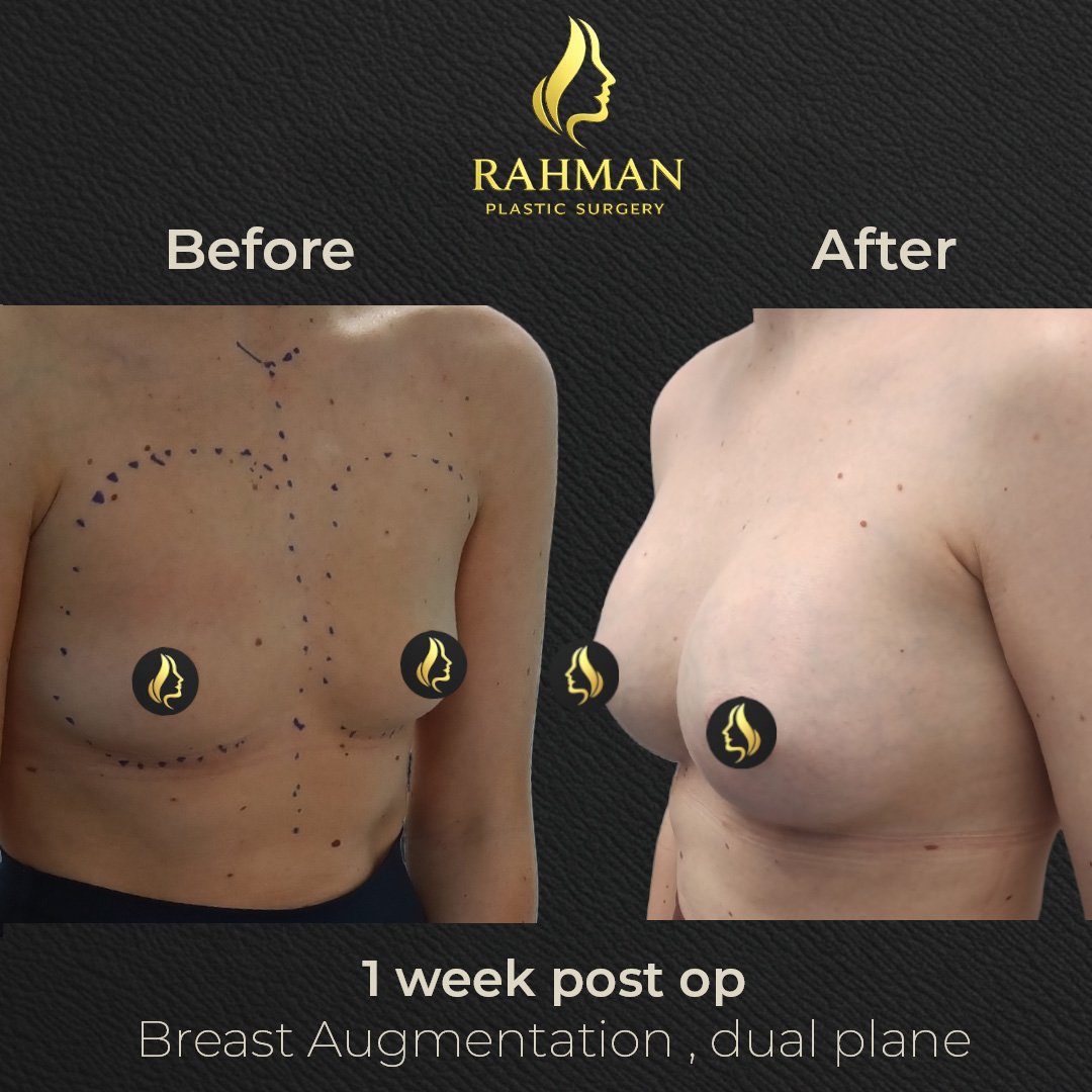 1 week Breast Aug.jpg