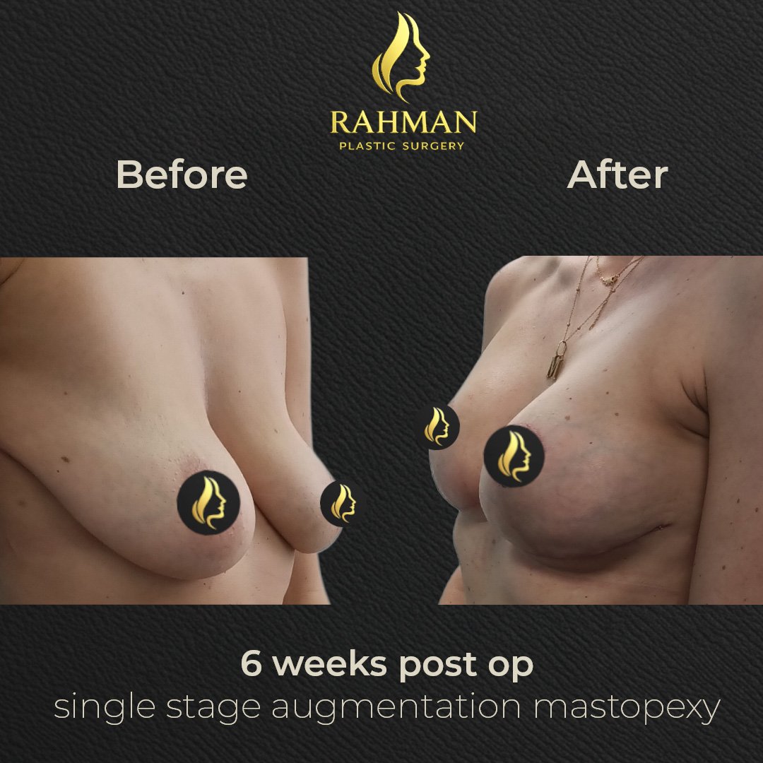 6 Week Breast Aug 3.jpg