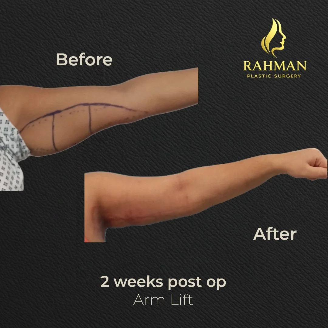 2 weeks Op Arm Lift.jpg