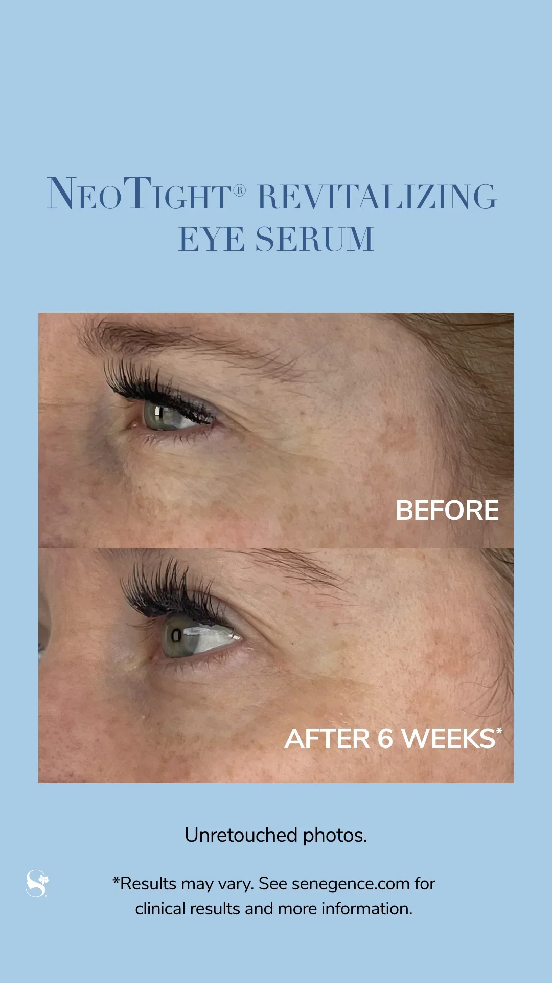 NZL-Social-Story-BeforeandAfter-NeoTight-EyeSerum-1.webp