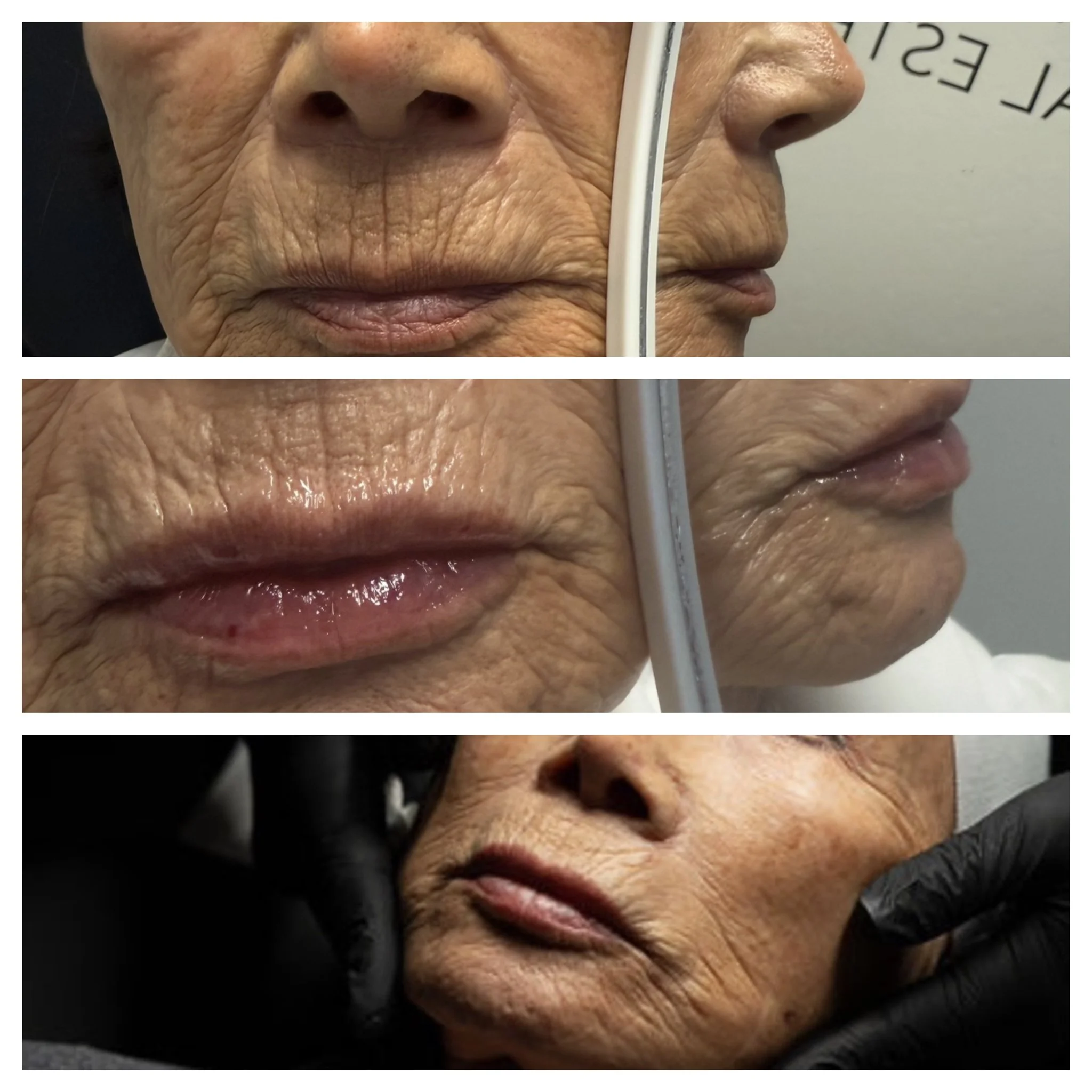 Revalis Aesthetics Medspa in Peoria, AZ, 85381 Botox, Fillers, Weight Loss