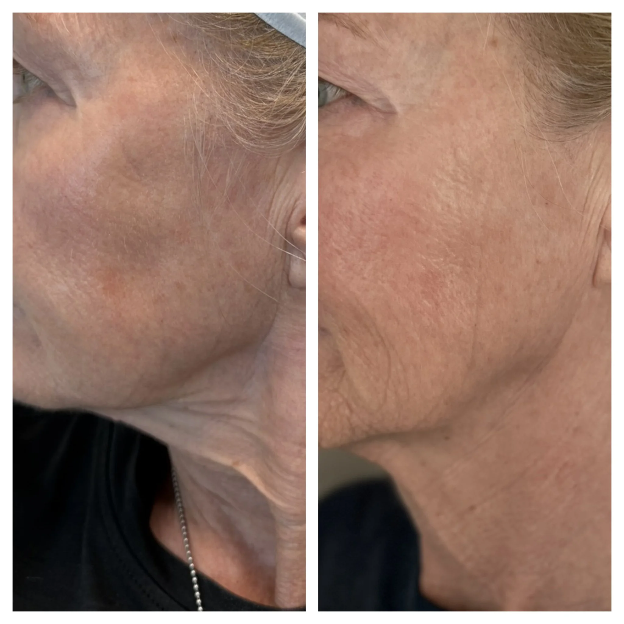 Revalis Aesthetics Medspa in Peoria, AZ, 85381 Botox, Fillers, Weight Loss