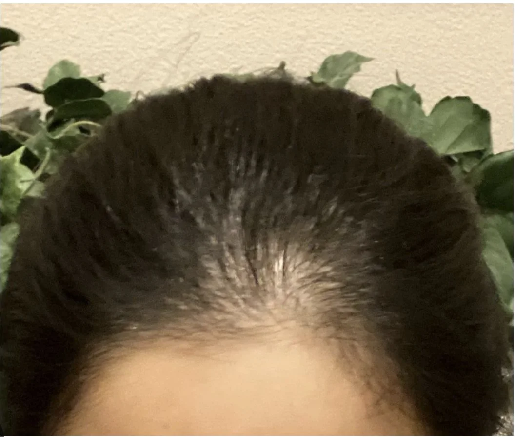 HAIR LOSS DURING MENOPAUSE: WHAT'S HAPPENING AND WHAT HELPS
